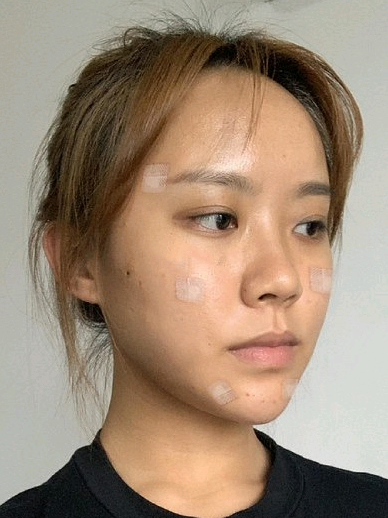 总感觉苹果肌下垂了,看起来整张脸都 是往下长的,所以就很焦虑,感觉是