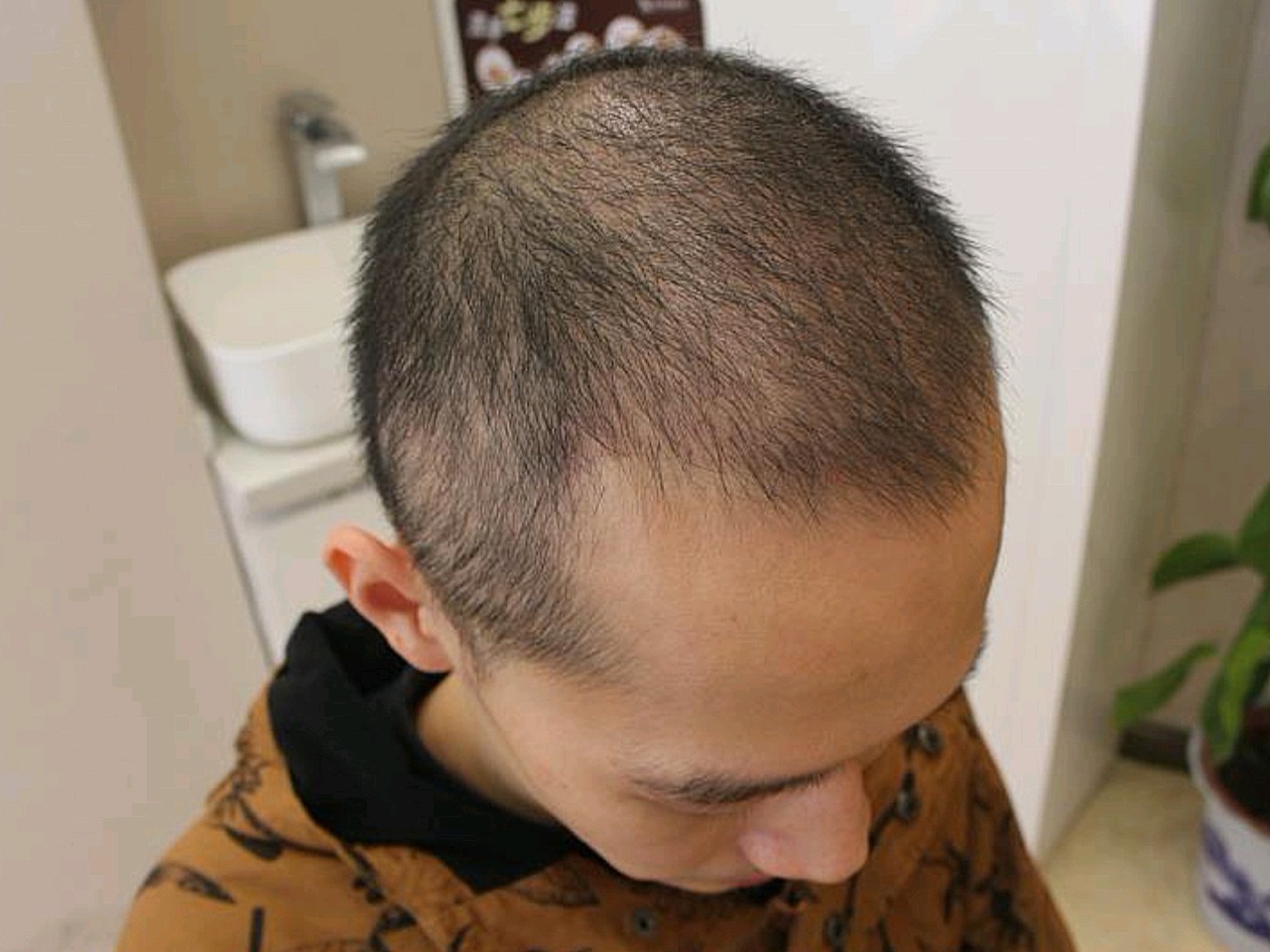 大麦微针植发术后60天:哈喽,不知不觉都已经过了两_圈子-新氧美容整形