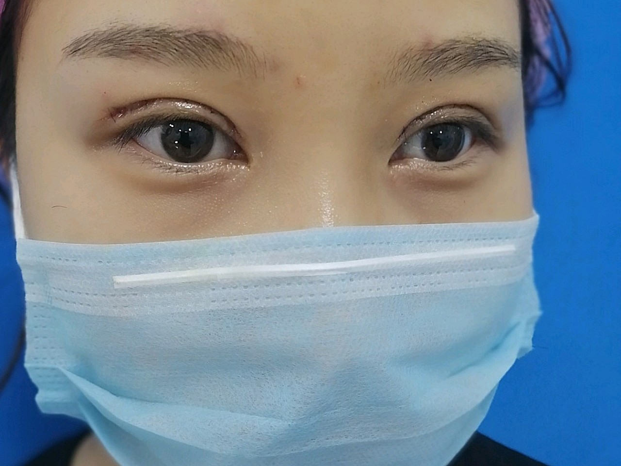 双眼皮术后一年,形态不好,太窄,给予修复