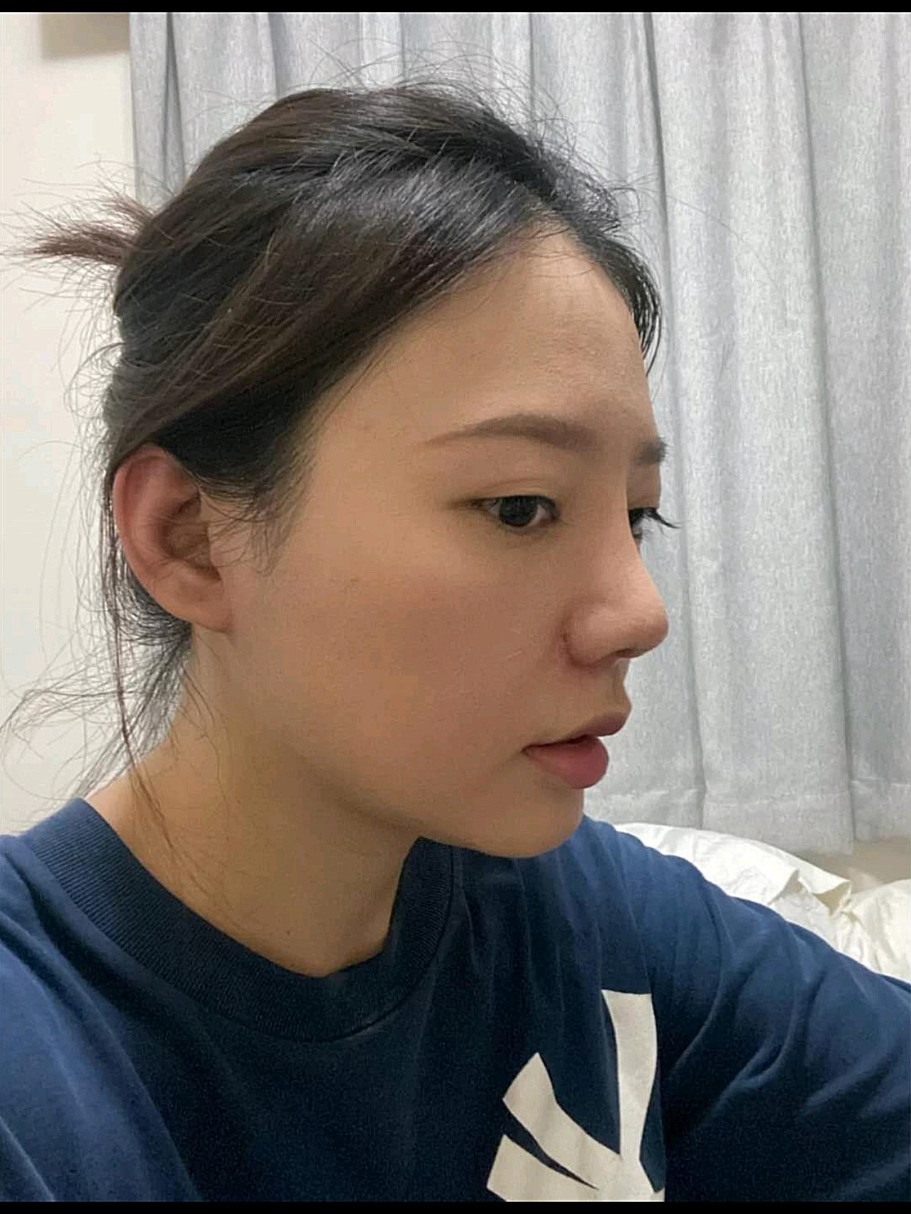 一开始感觉怪怪的,山根这块突然高了很_圈子-新氧美容整形