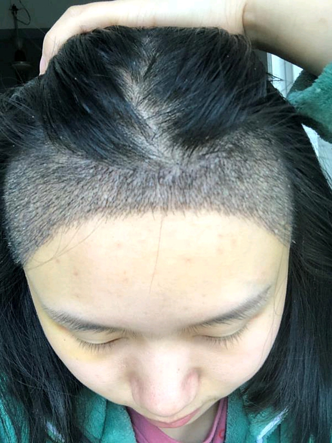 植发十天看着这毛桩桩感觉好神奇啊,一下就有头发了!