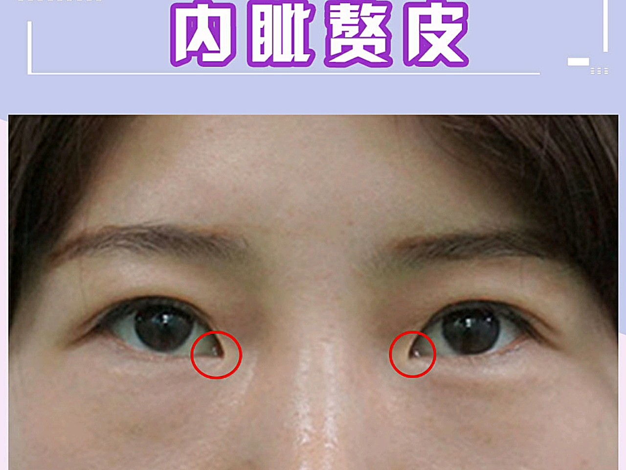 但是有一些人在做完切开的双眼皮之后也出现了双眼皮变浅,甚至是消失