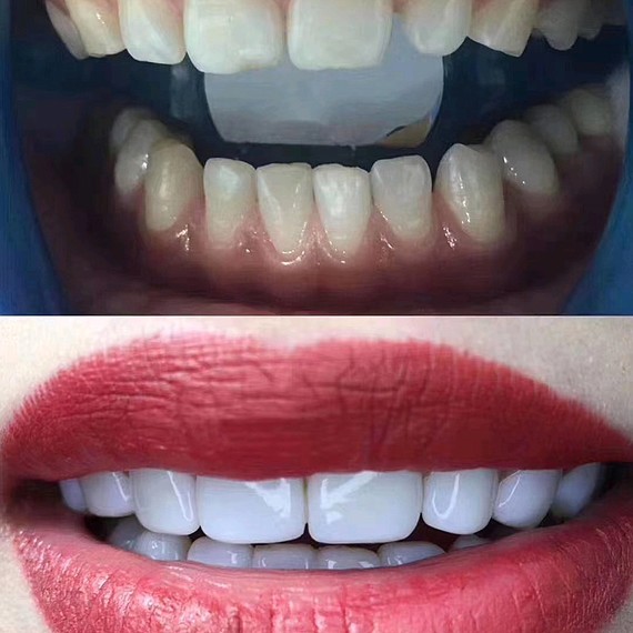 原来明星的小白牙都是这么操作的,两个小时