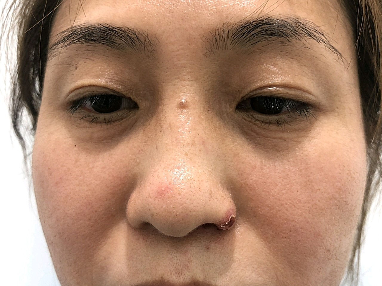 术前:我的皮肤状态一直不佳:毛孔粗大,暗沉发黄无光_圈子-新氧美容整