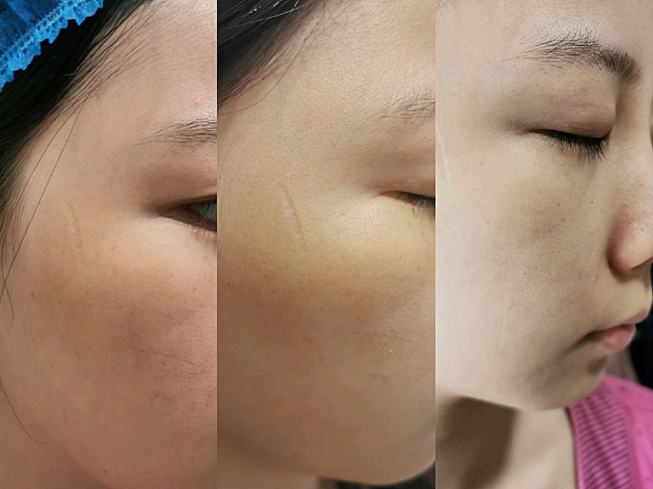 777777终于熬到光子嫩肤术后的第七天,感觉自己的反黑_圈子