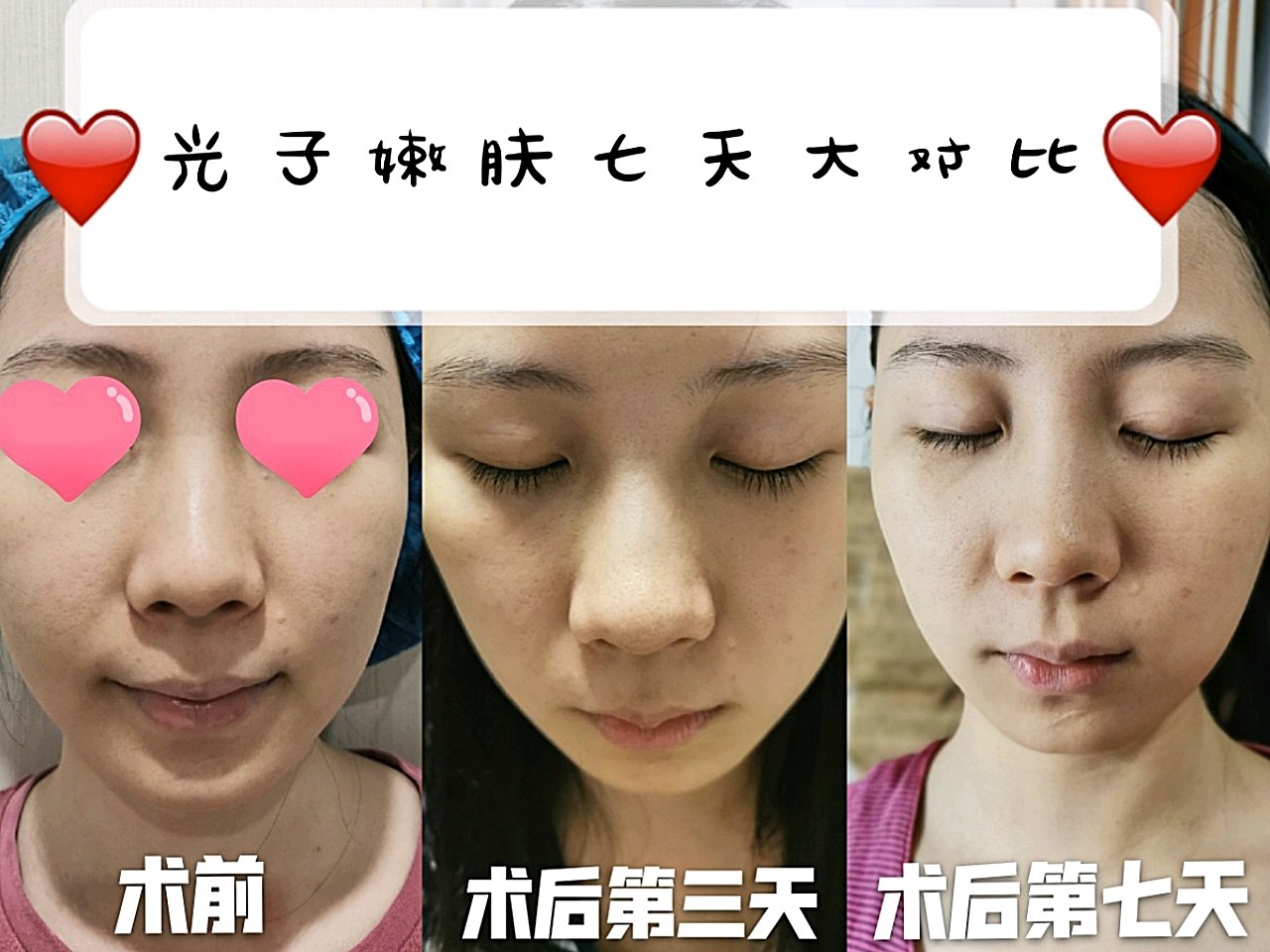 777777终于熬到光子嫩肤术后的第七天,感觉自己的反黑_圈子