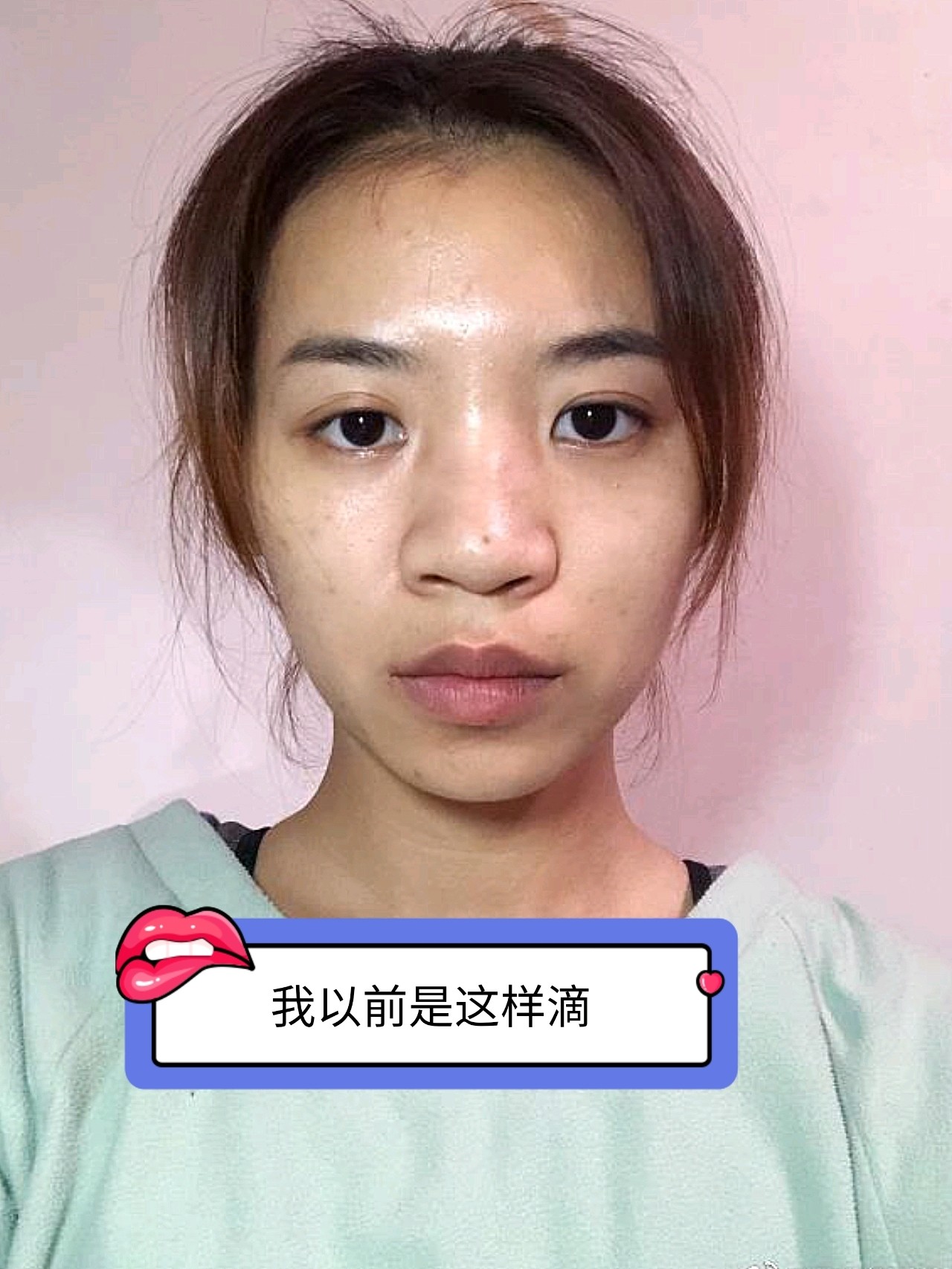 鼻型美化:打了玻尿酸沒隆起來,反而鼻子寬了,上一家_圈子-新氧美容