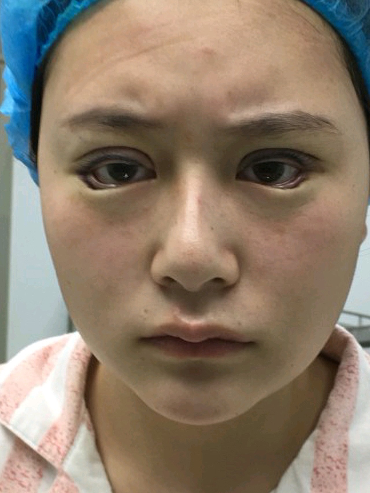 做双眼皮的时候我还一起做了下至,主要就是想要更大的眼睛