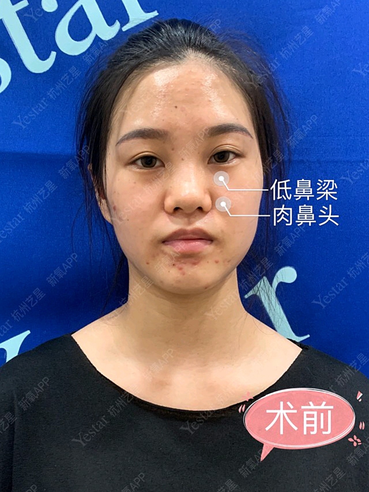 肉鼻子,蒜头鼻如何改善