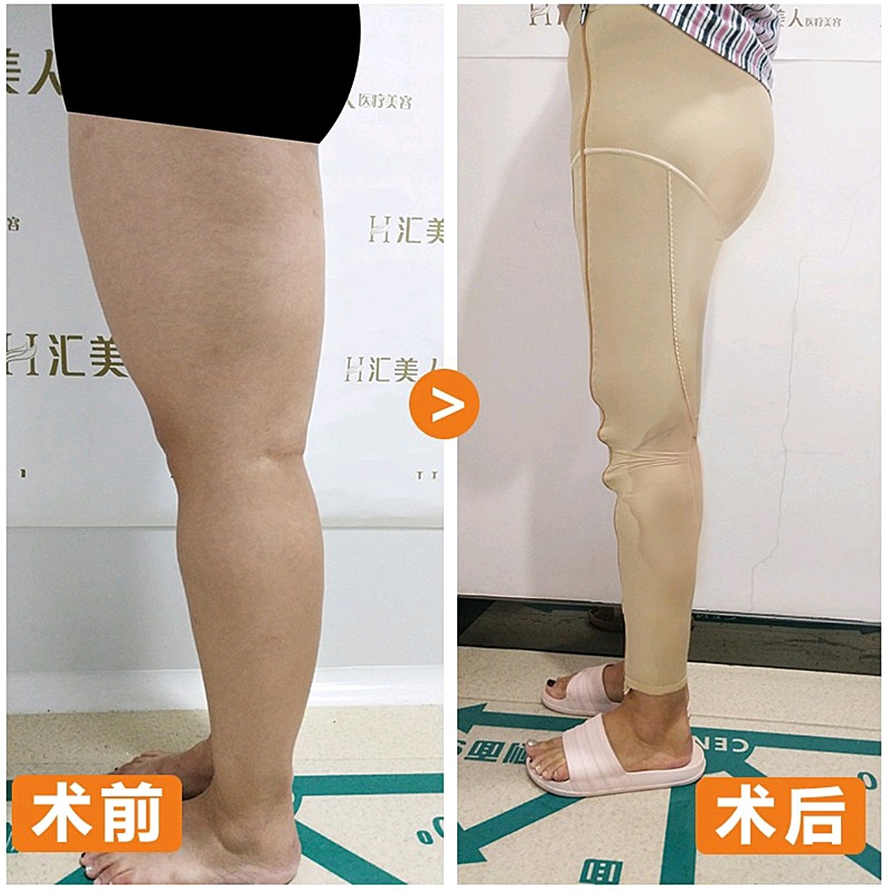 【沈阳汇美人大腿 小腿吸脂术后第0天】