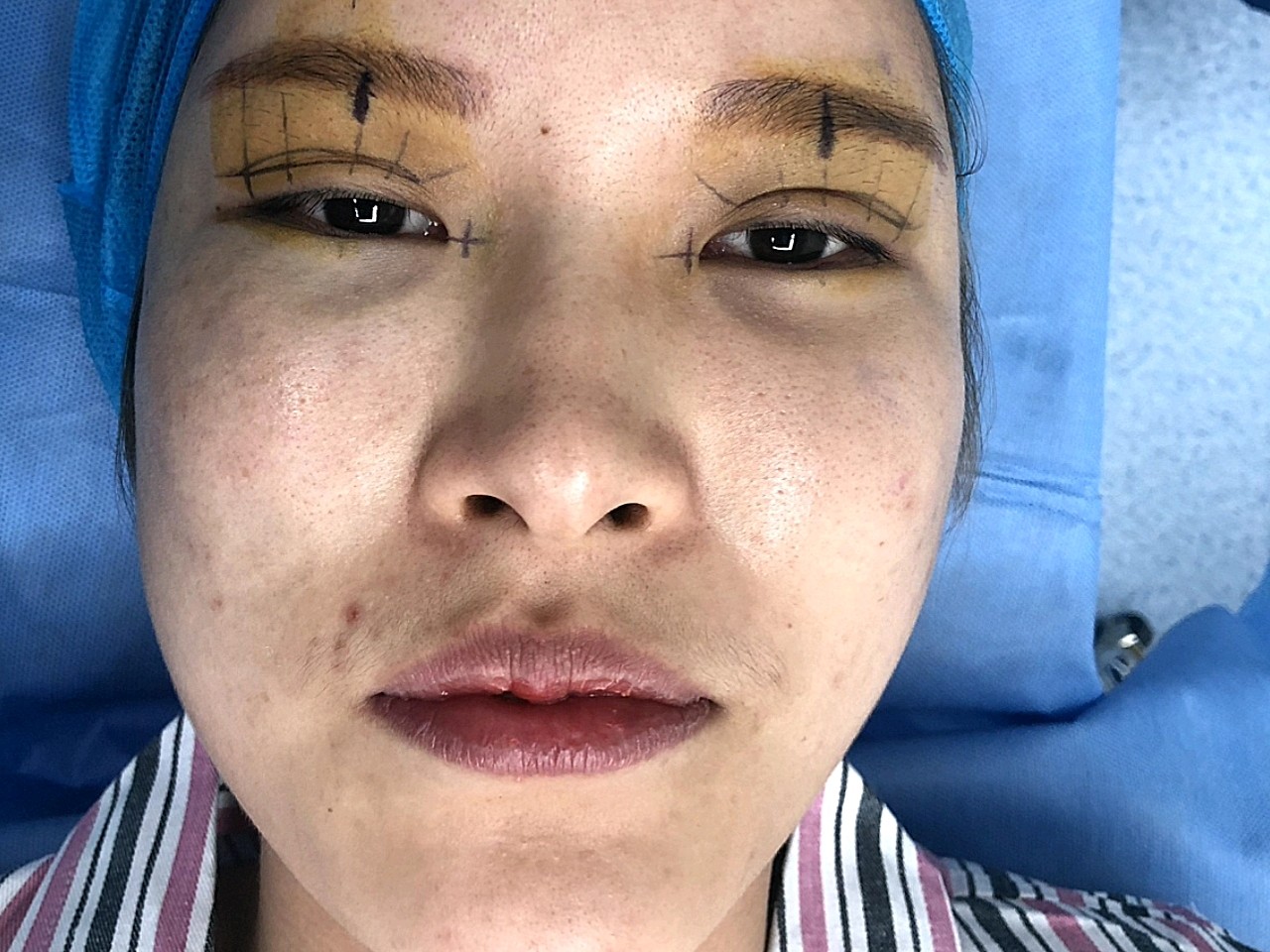 做了眼睛又做了线雕,它有一个很厉害的名字,叫时光06_圈子-新氧美容