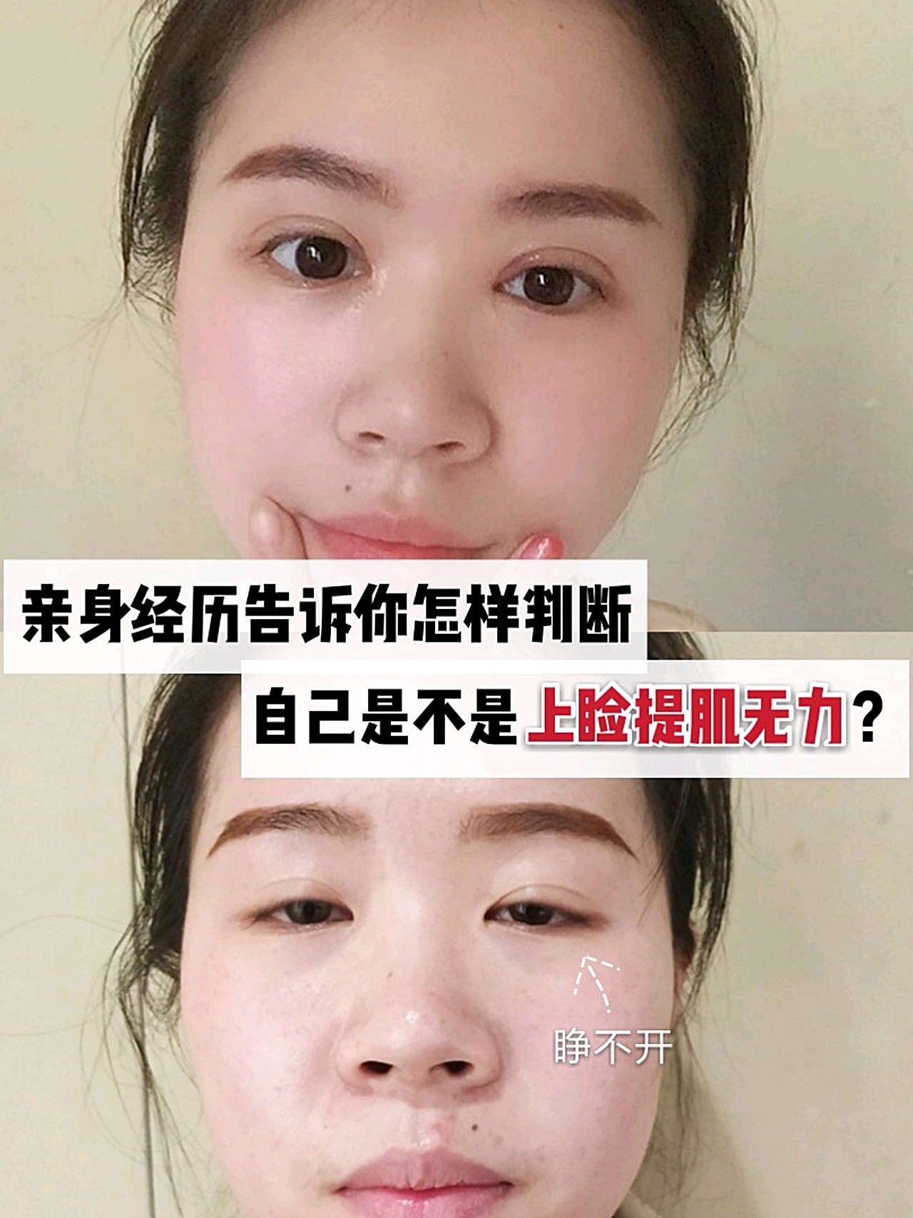 亲身经历告诉你怎样判断自己是不是上睑提肌无力