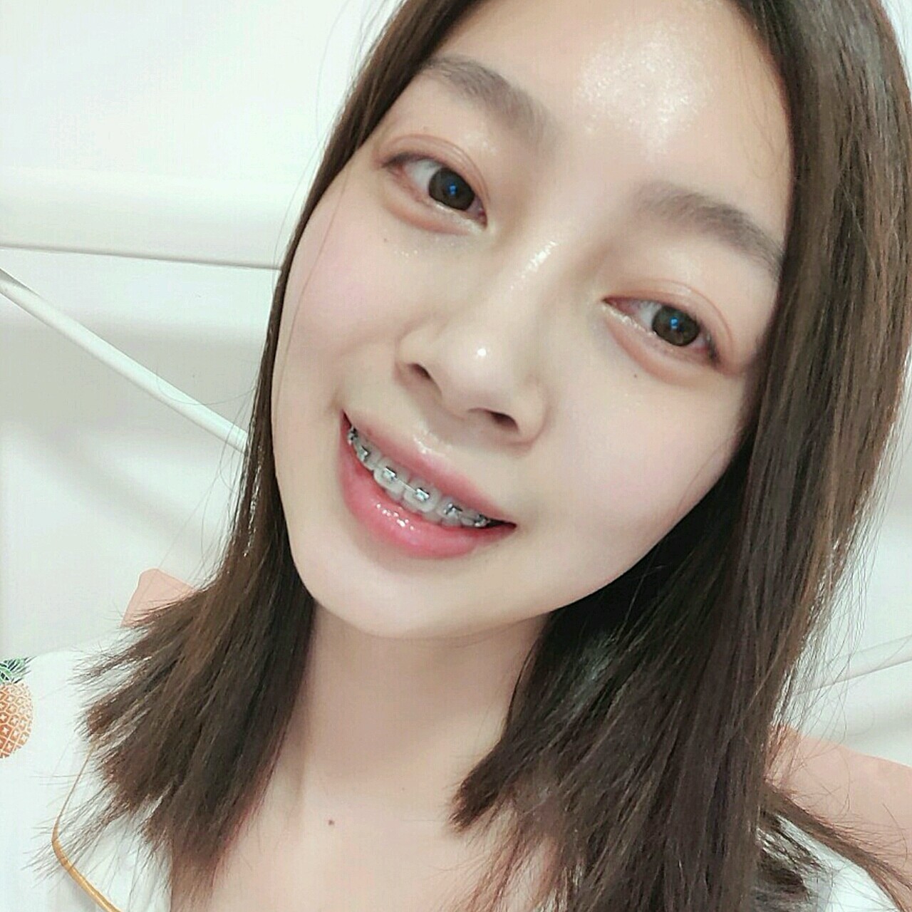 金属自锁矫正第2篇这个月终于在拔牙之后戴上了牙套,_圈子-新氧美容