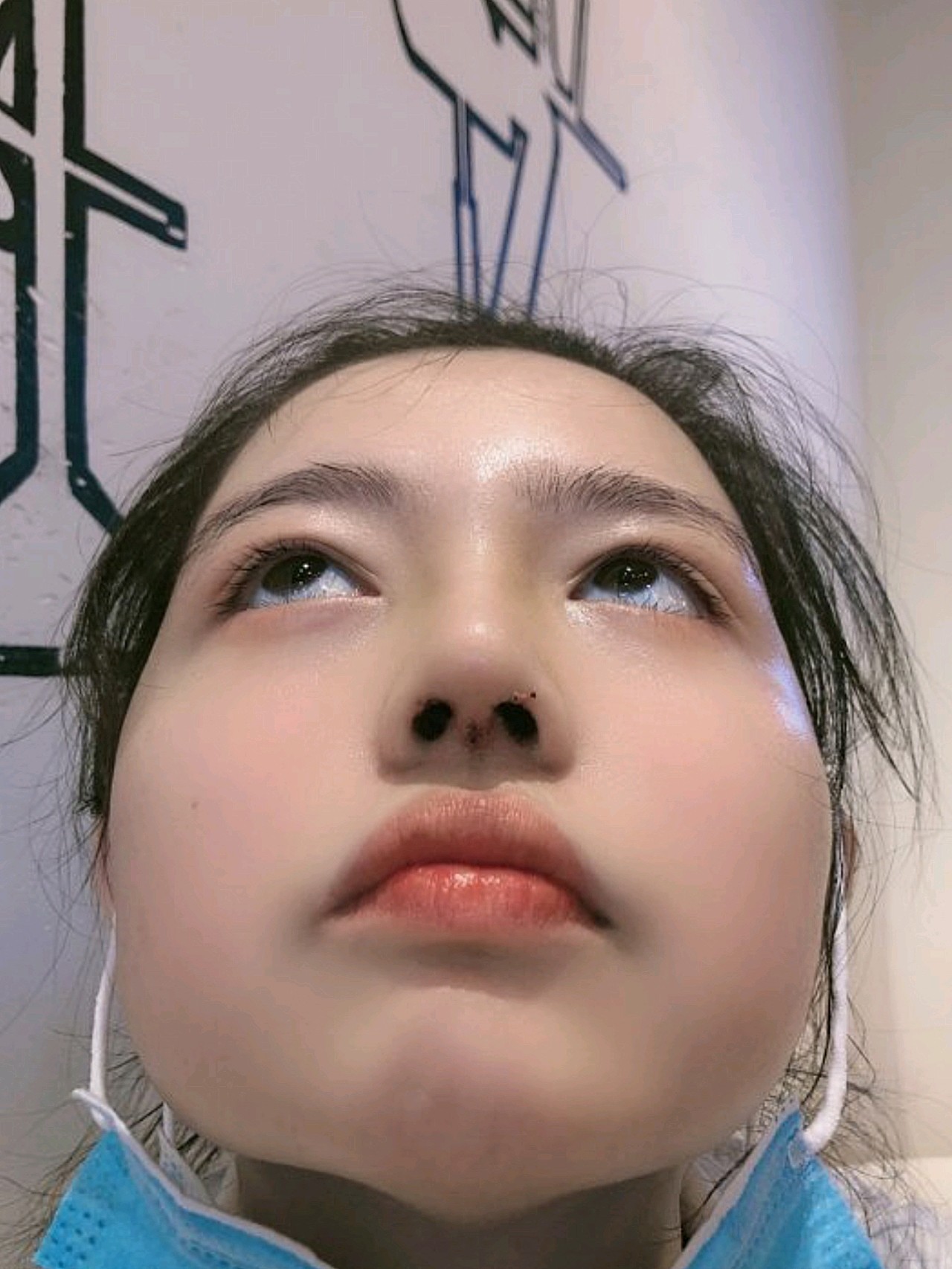 我做了缩鼻翼 垫鼻梁 鼻基底填充!鼻梁我垫的薄,鼻_圈子-新氧美容整形