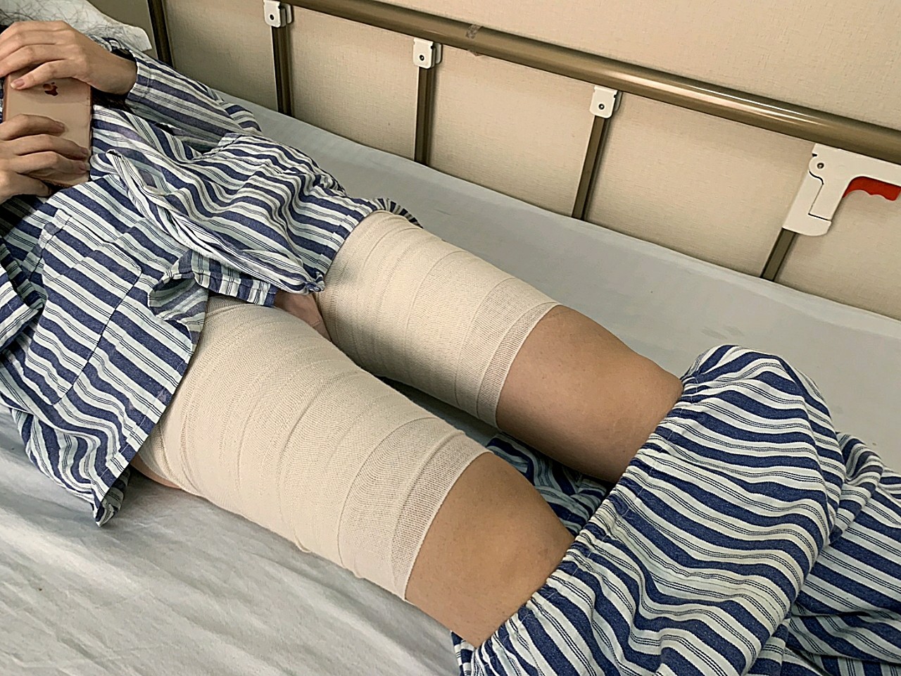 大腿,腹部环吸抽脂手术术后第3天 刚做完手术之后我_圈子-新氧美容