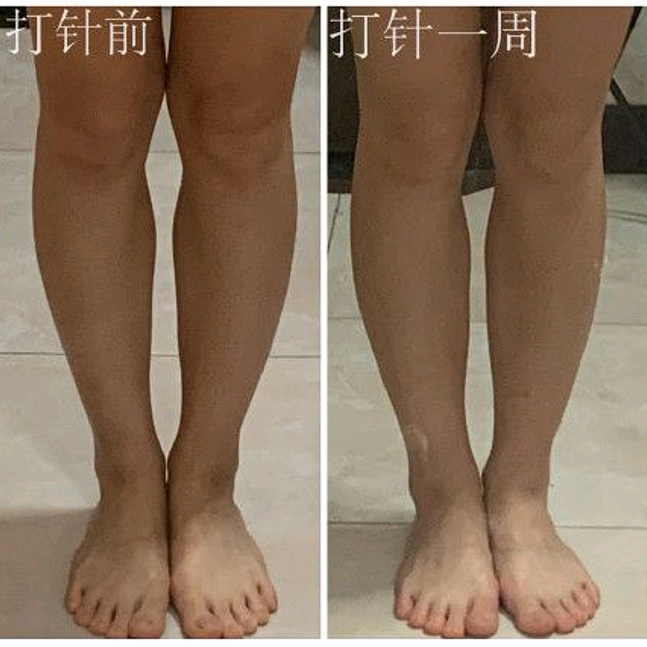 小腿内侧打了300u得瘦腿针,因为小腿肌肉过于发达_圈子-新氧美容整形