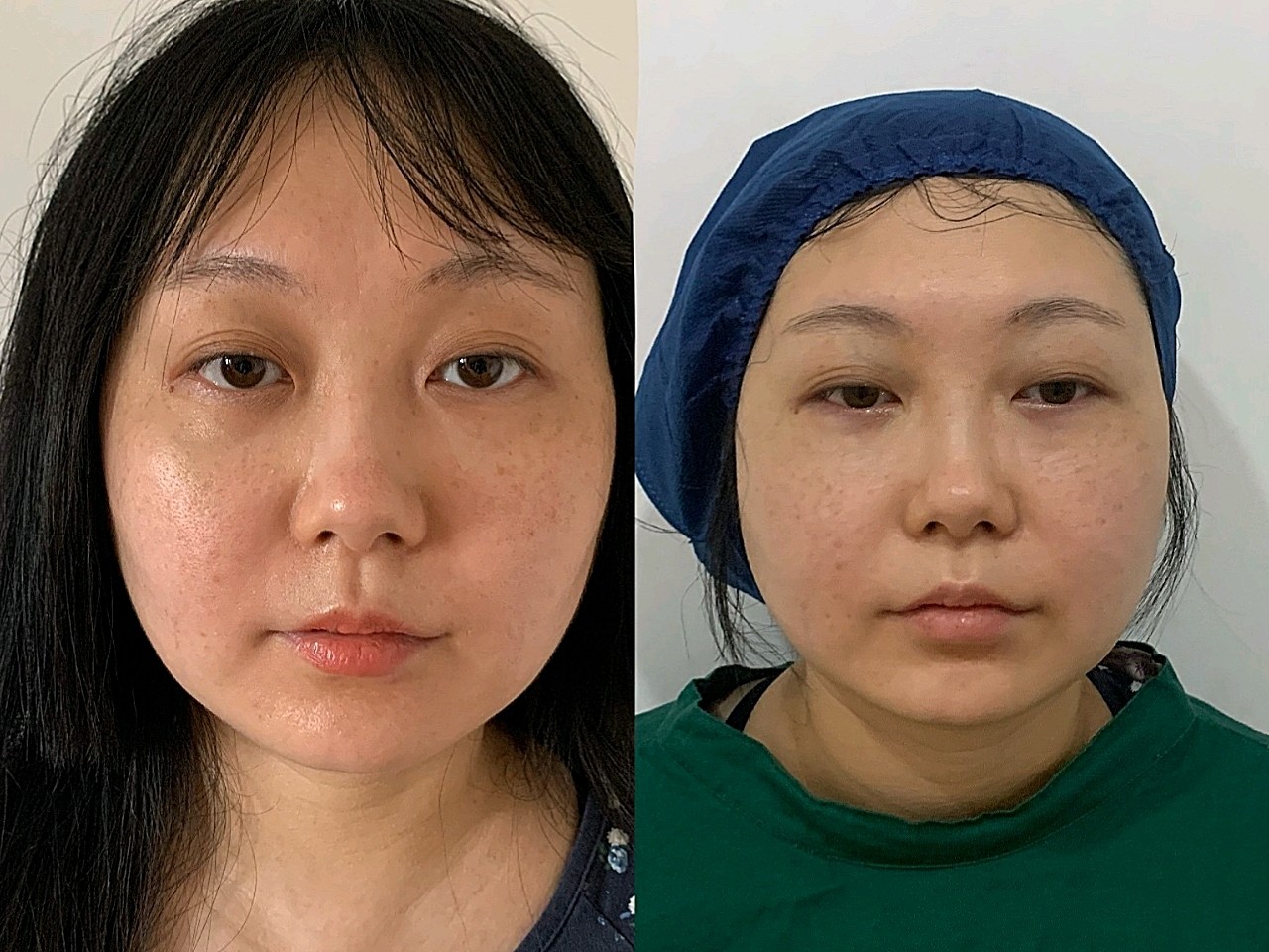 一千多度近视的金鱼眼让我戴隐形都得带个_圈子-新氧美容整形