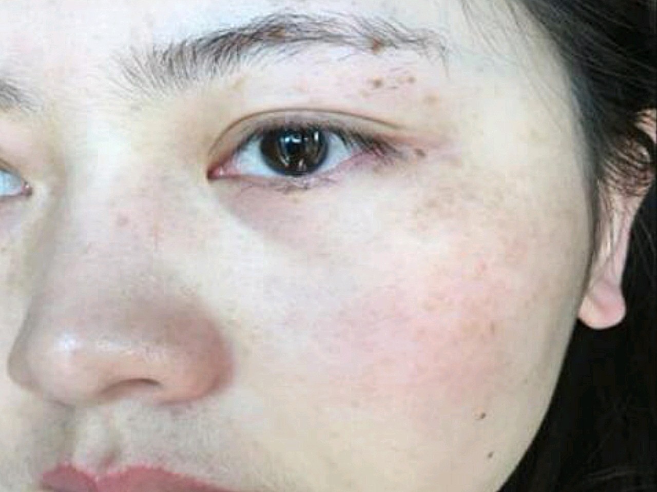 我是褐青色痣 少量雀斑,雀斑比较难搞,褐青色痣祛除_圈子-新氧美容