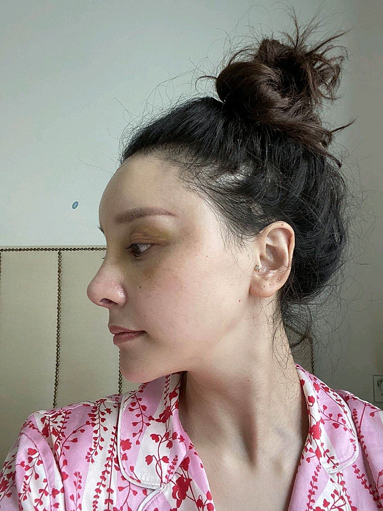 全脸大改造(鼻修复 小切口拉皮 小项目)术后21天_圈子-新氧美容整形