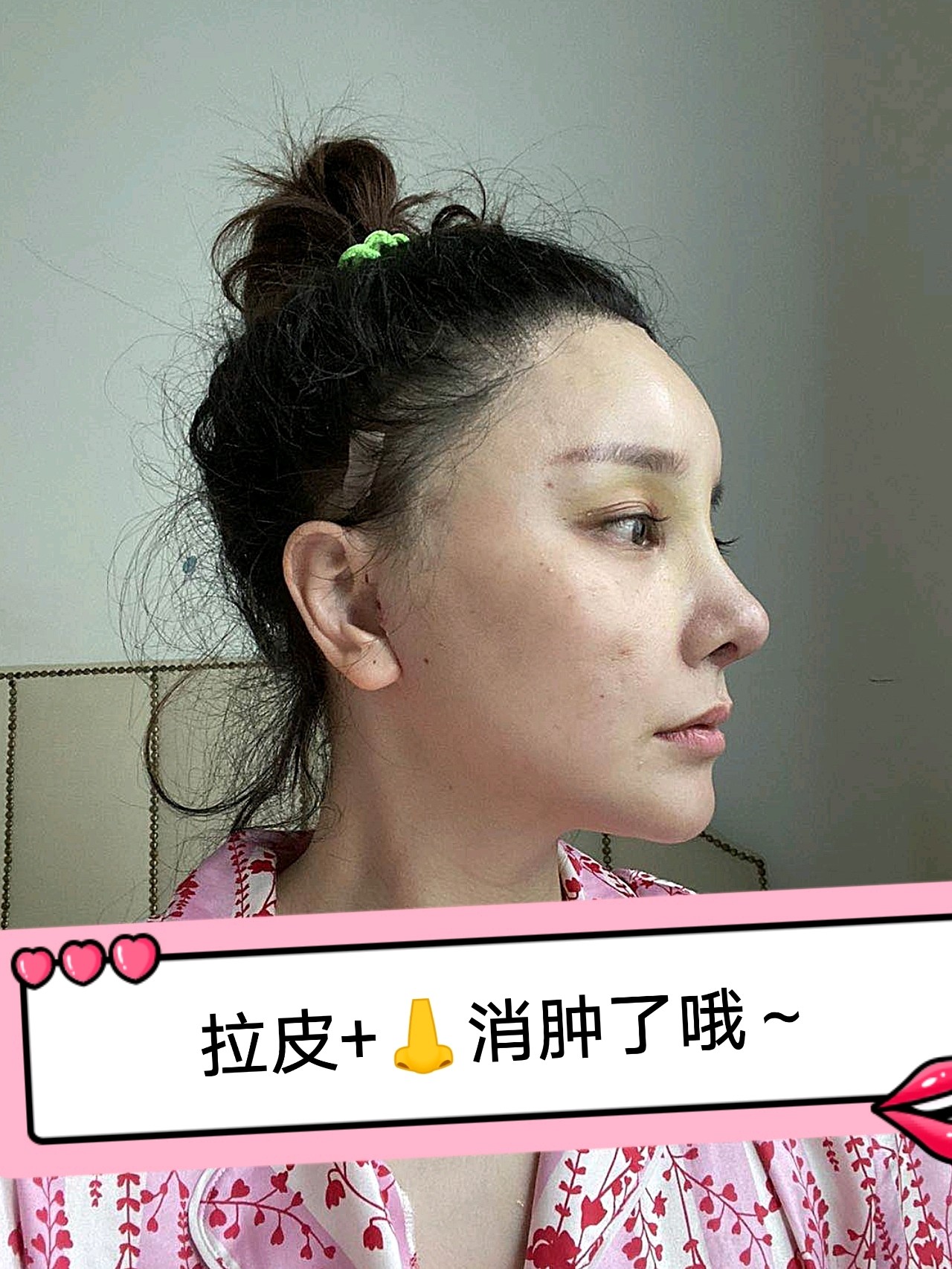 全脸大改造(鼻修复 小切口拉皮 小项目)术后21天_圈子-新氧美容整形