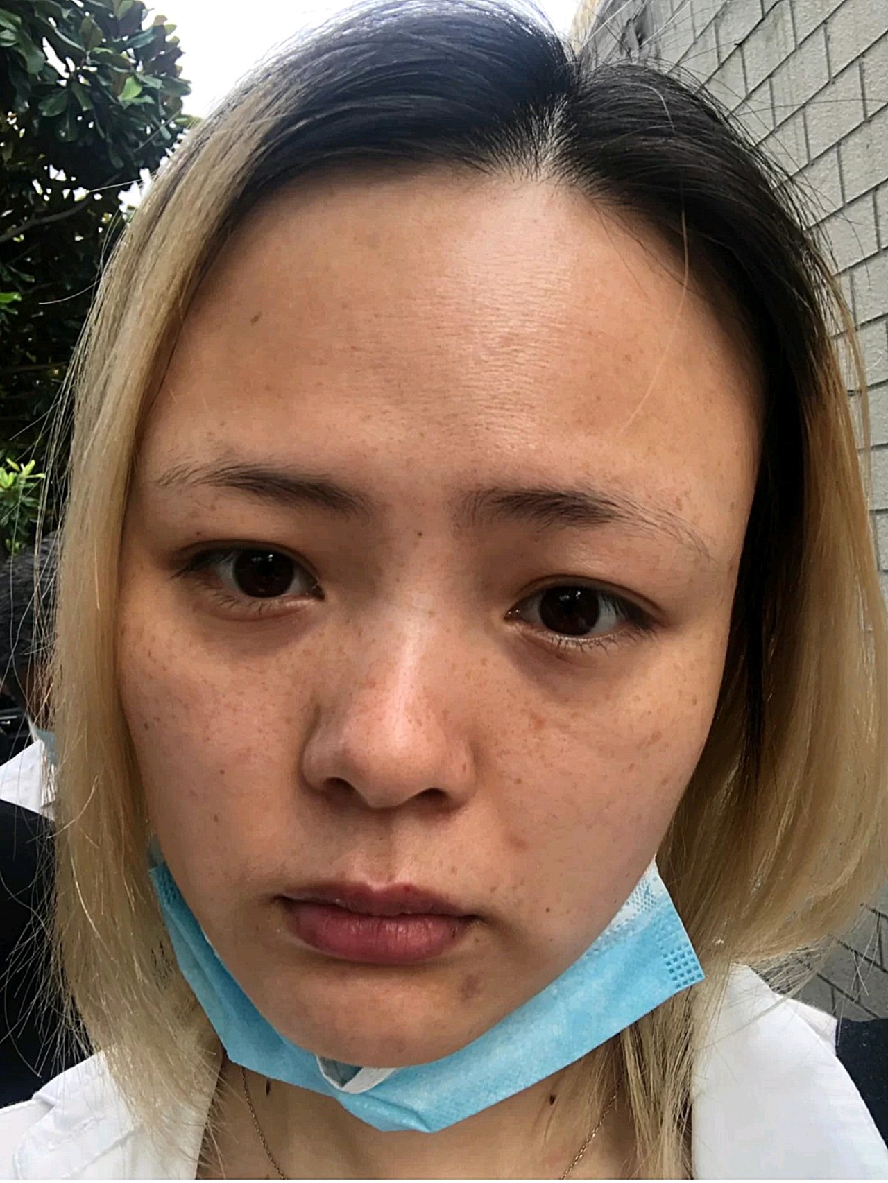 做皮秒的第8天了.嘿,我来分享啦.19号上午做的皮_圈子-新氧美容整形