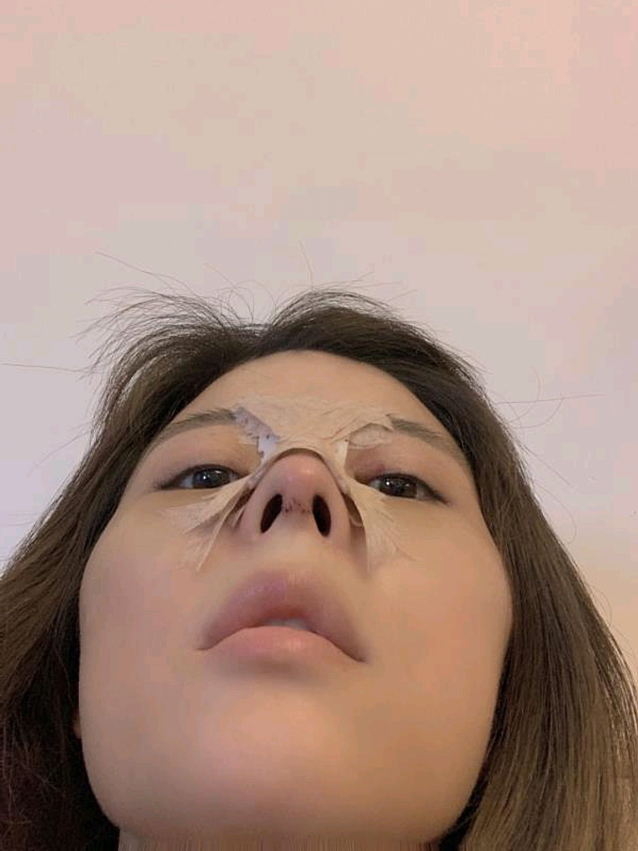 这是我术后三天的恢复照片,鼻子被包的严严实实的,好_圈子-新氧美容