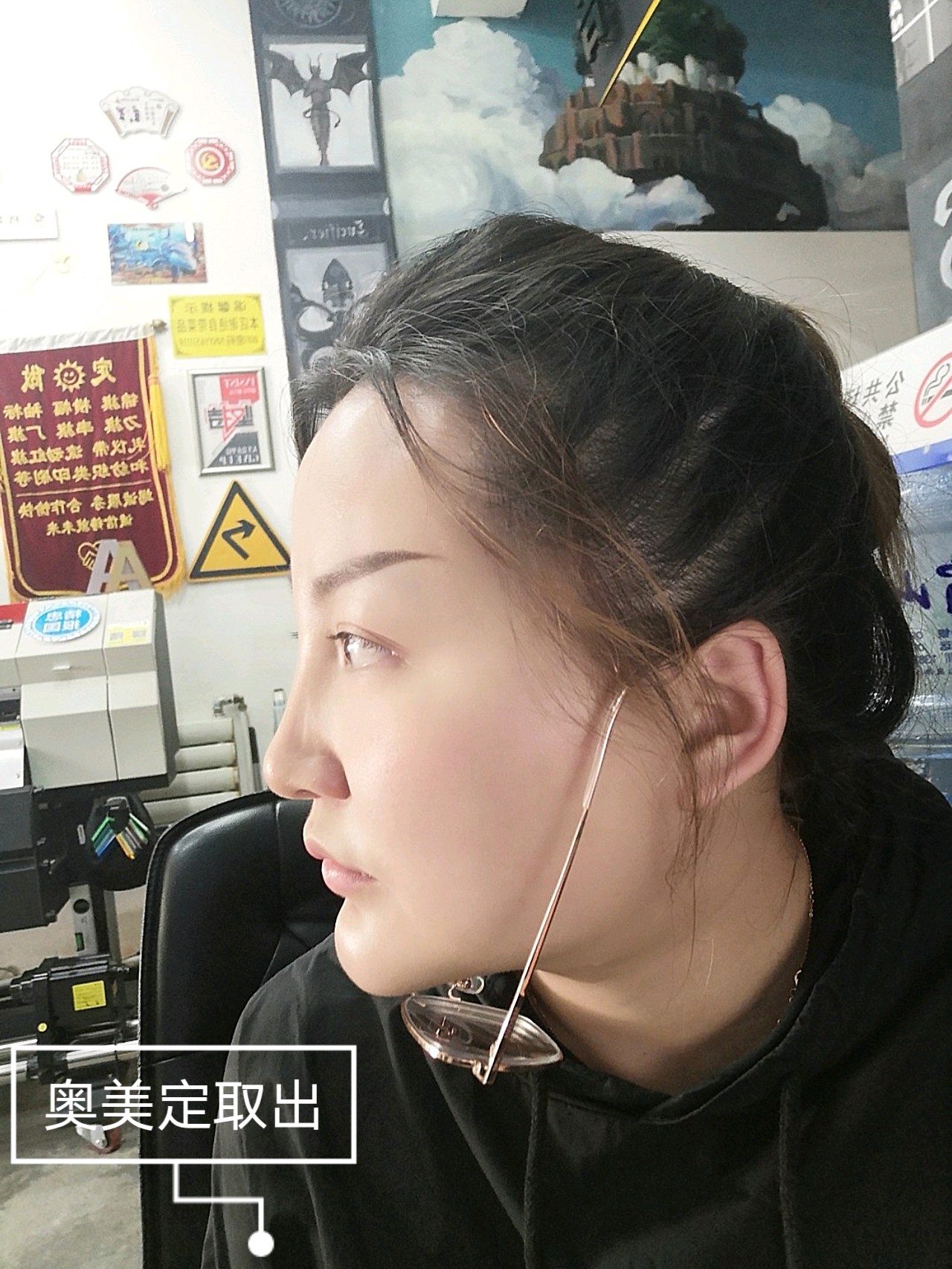 奥美定取出一个月零10天了,感觉现在下巴还是有点硬_圈子-新氧美容