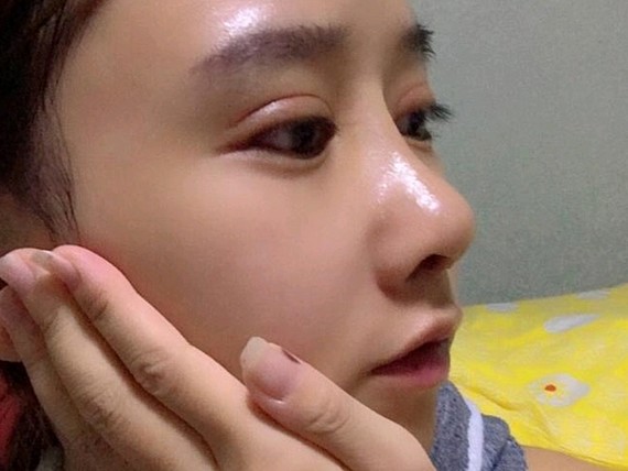 96鼻小柱歪到姥姥家71再不修复真的要丑到过年631593今