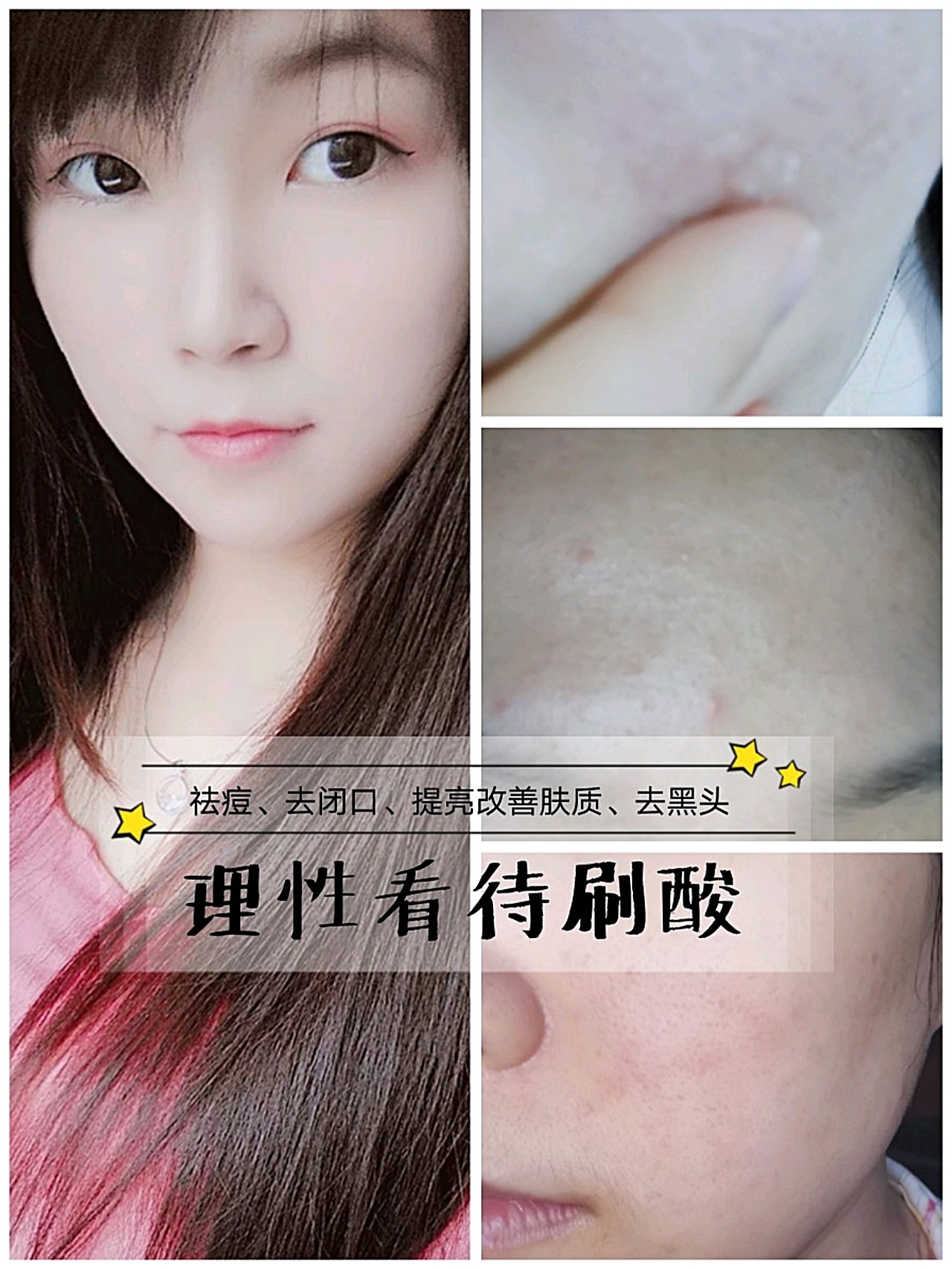 噔噔噔噔,刷酸后的五天过完啦……效果到底怎么样呢?