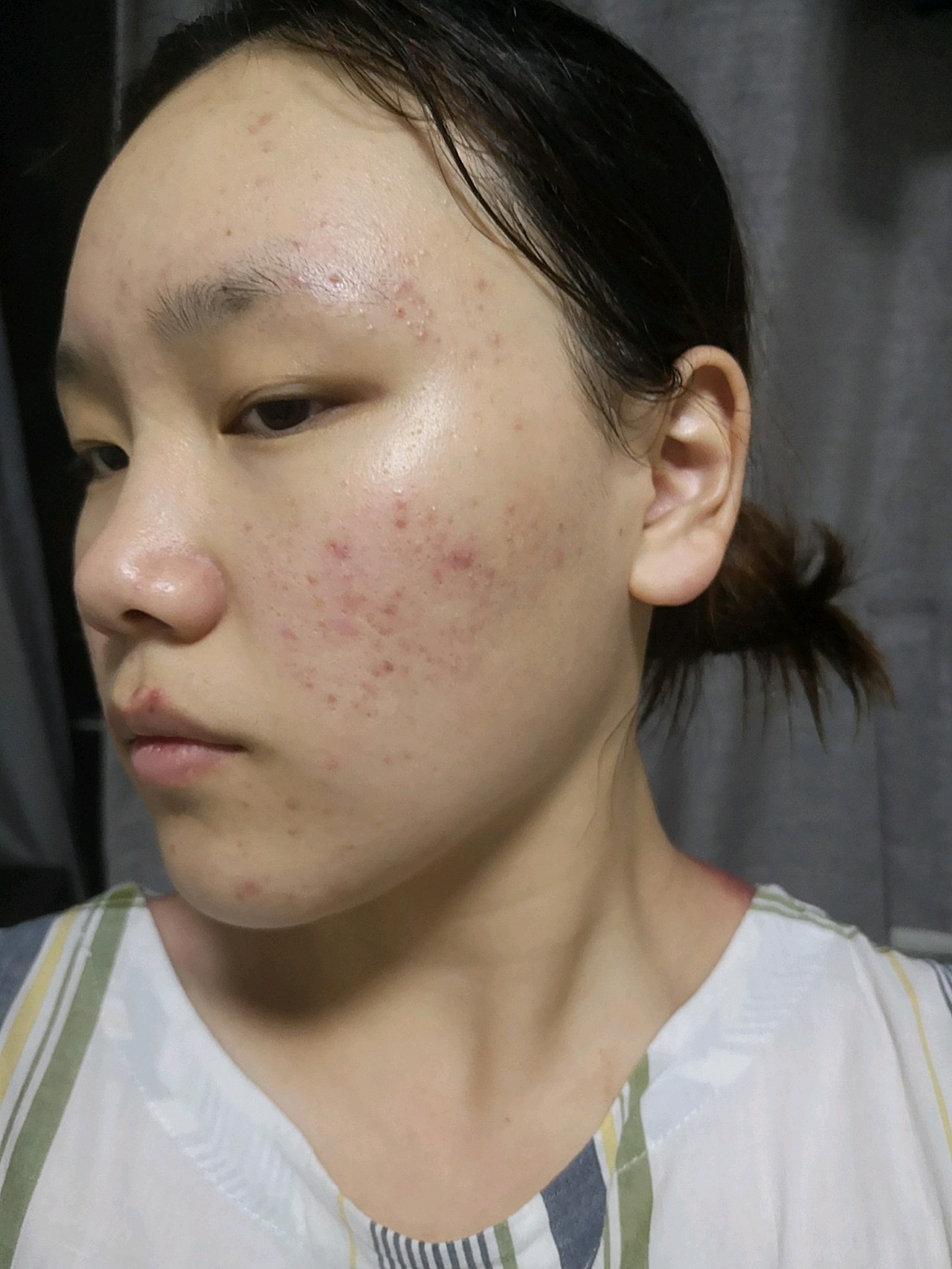 去医院的当天做了皮肤检测和面诊,我自己的皮肤问题主要就是红肿痘痘