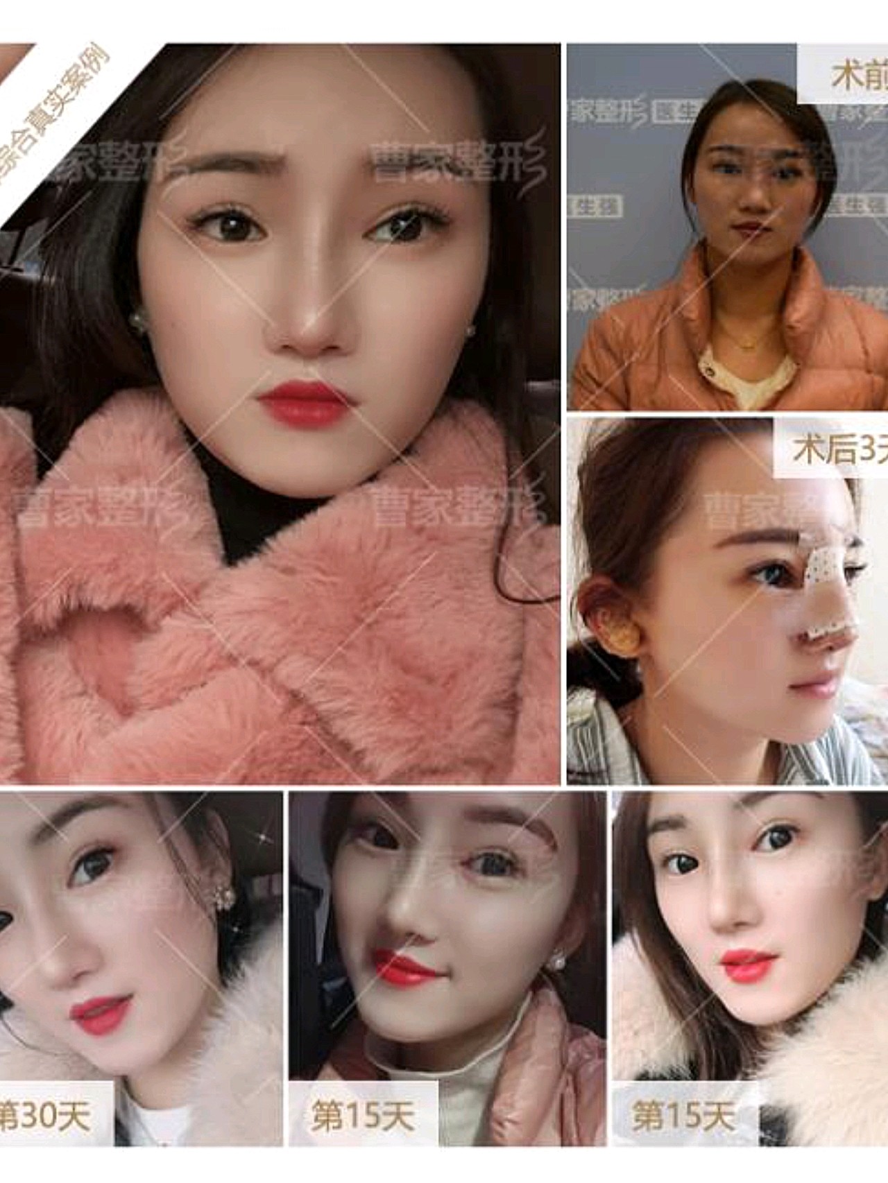 鼻小柱下垂,鼻翼缘后缩,有点像兔鼻,缺少女性的美,鼻子偏男性化,在