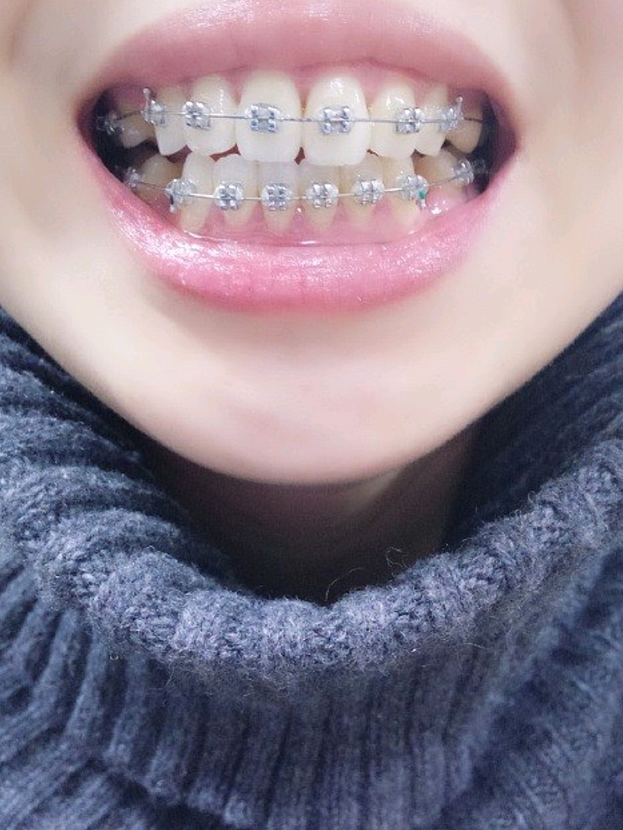 牙齿矫正第47天