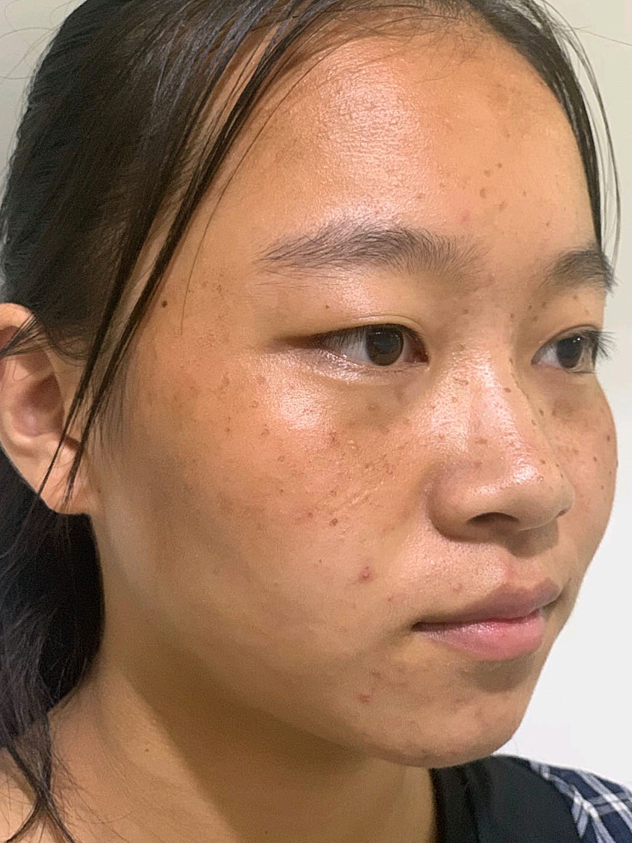 效果情况:脸上的斑去掉了,效果很好,两年多了也没有_圈子-新氧美容