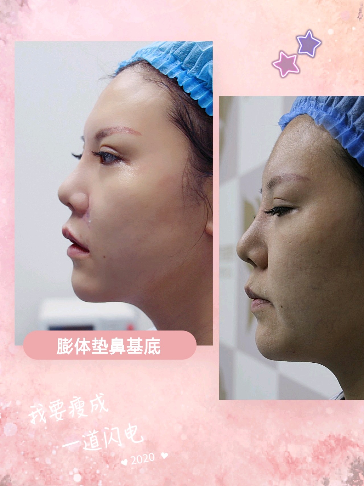 济南美辰膨体垫鼻基底术后3天分享