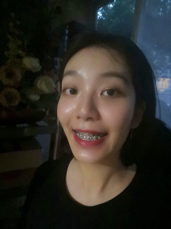 钢牙妹的91天,每次复诊的前两天加力感觉比较酸爽;_圈子-新氧美容整形