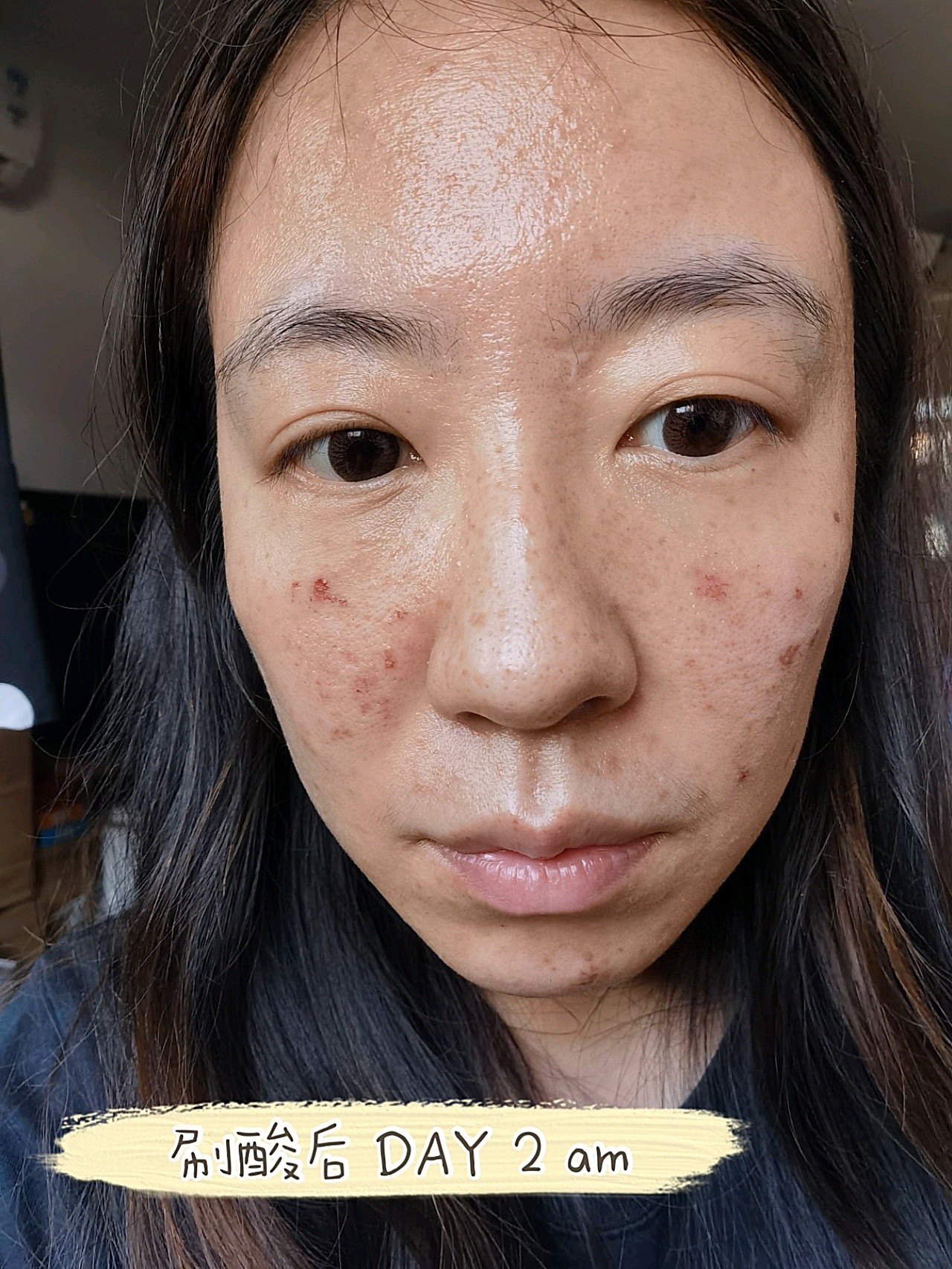 迪玛丝缇千人刷酸体验