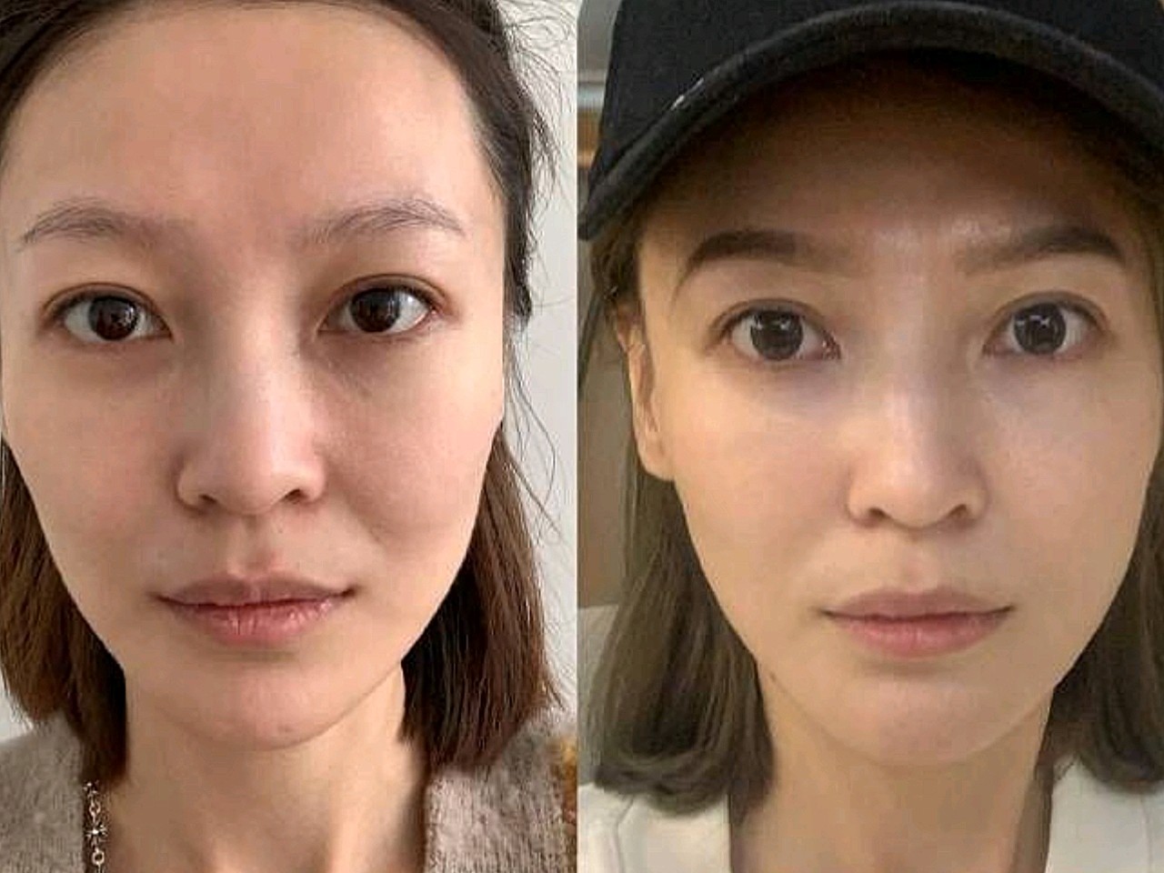 过了25岁衰老开始加速,尤其是面部,松弛下垂法令纹_圈子-新氧美容整形