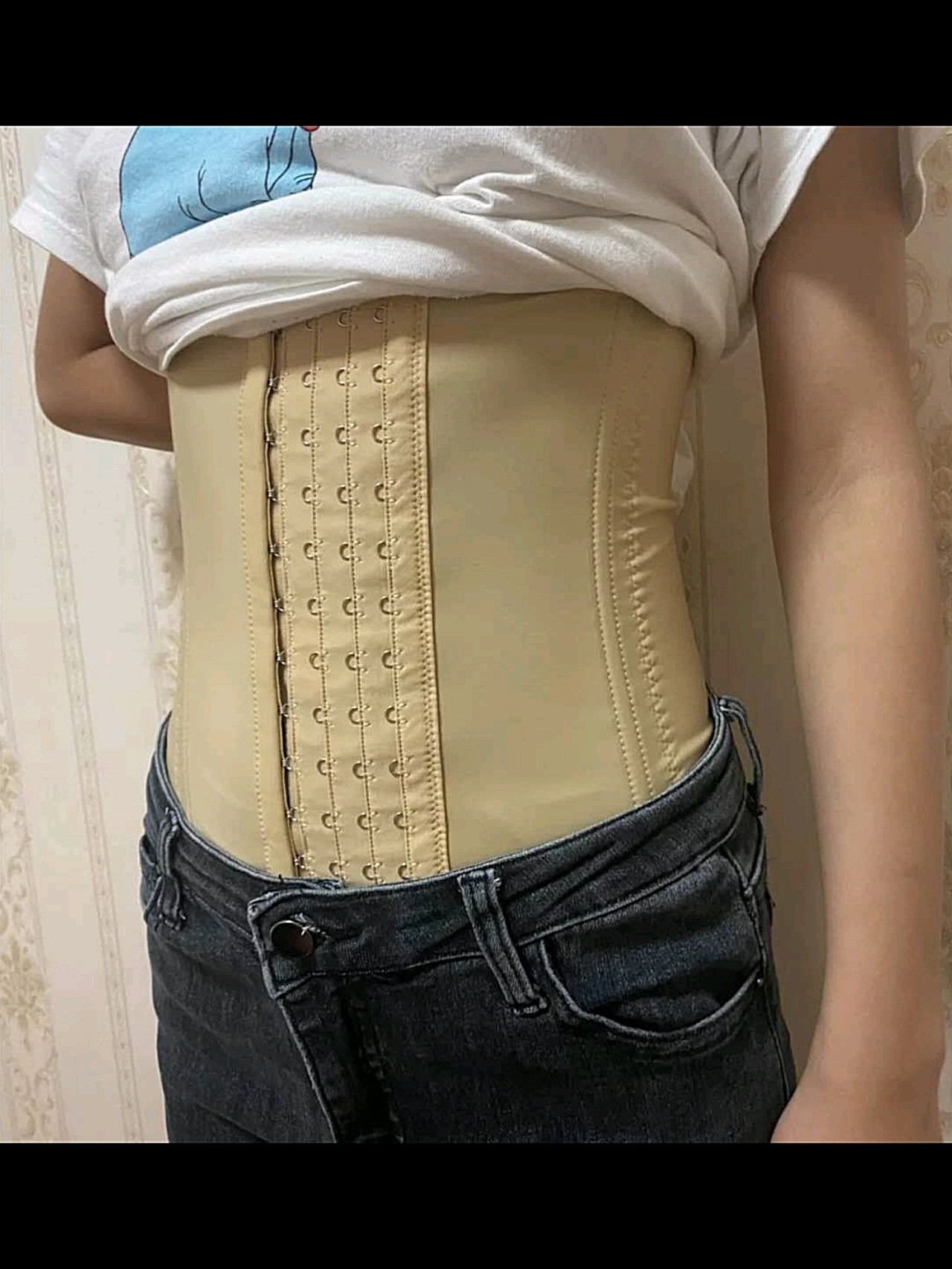 【沈阳汇美人腰腹吸脂术后第4天】