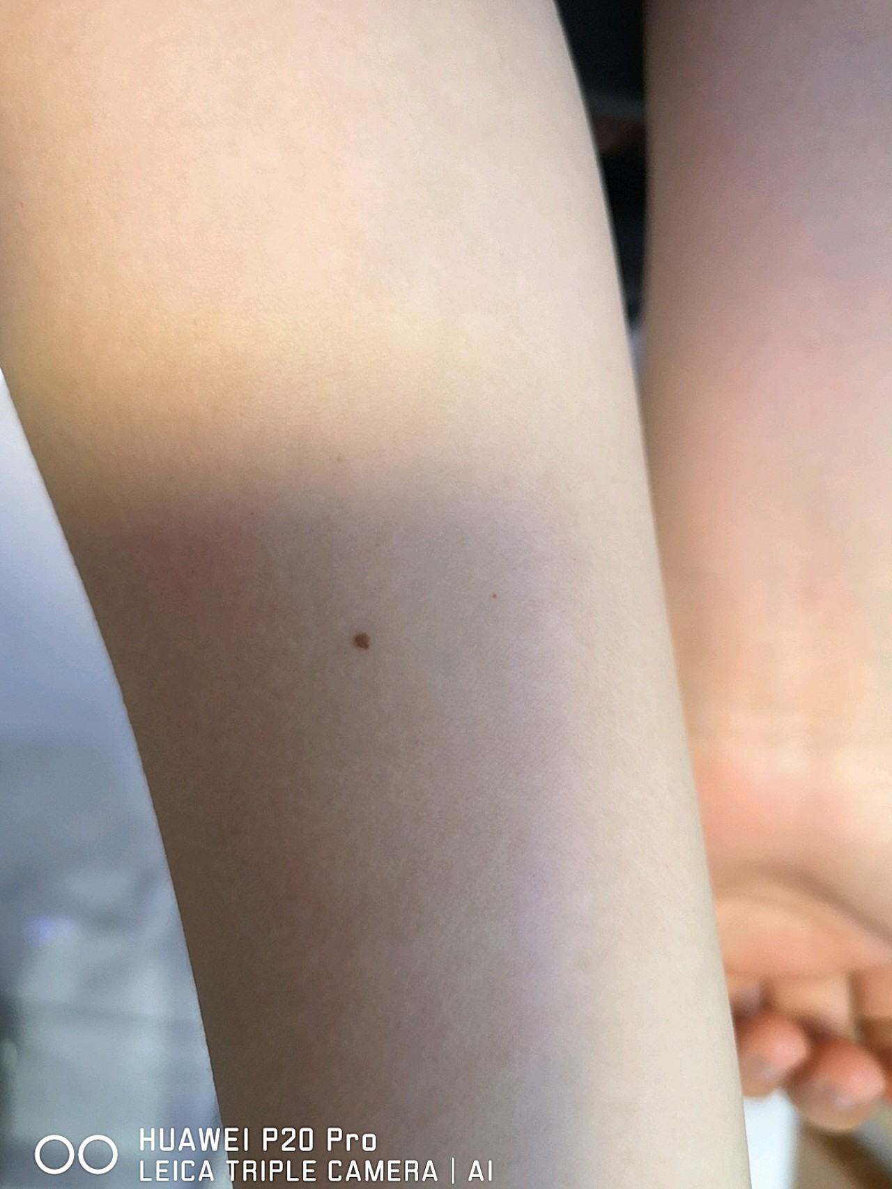 点了脸上几颗小和手臂上的痣,看起来干净多了,我的痣_圈子-新氧美容