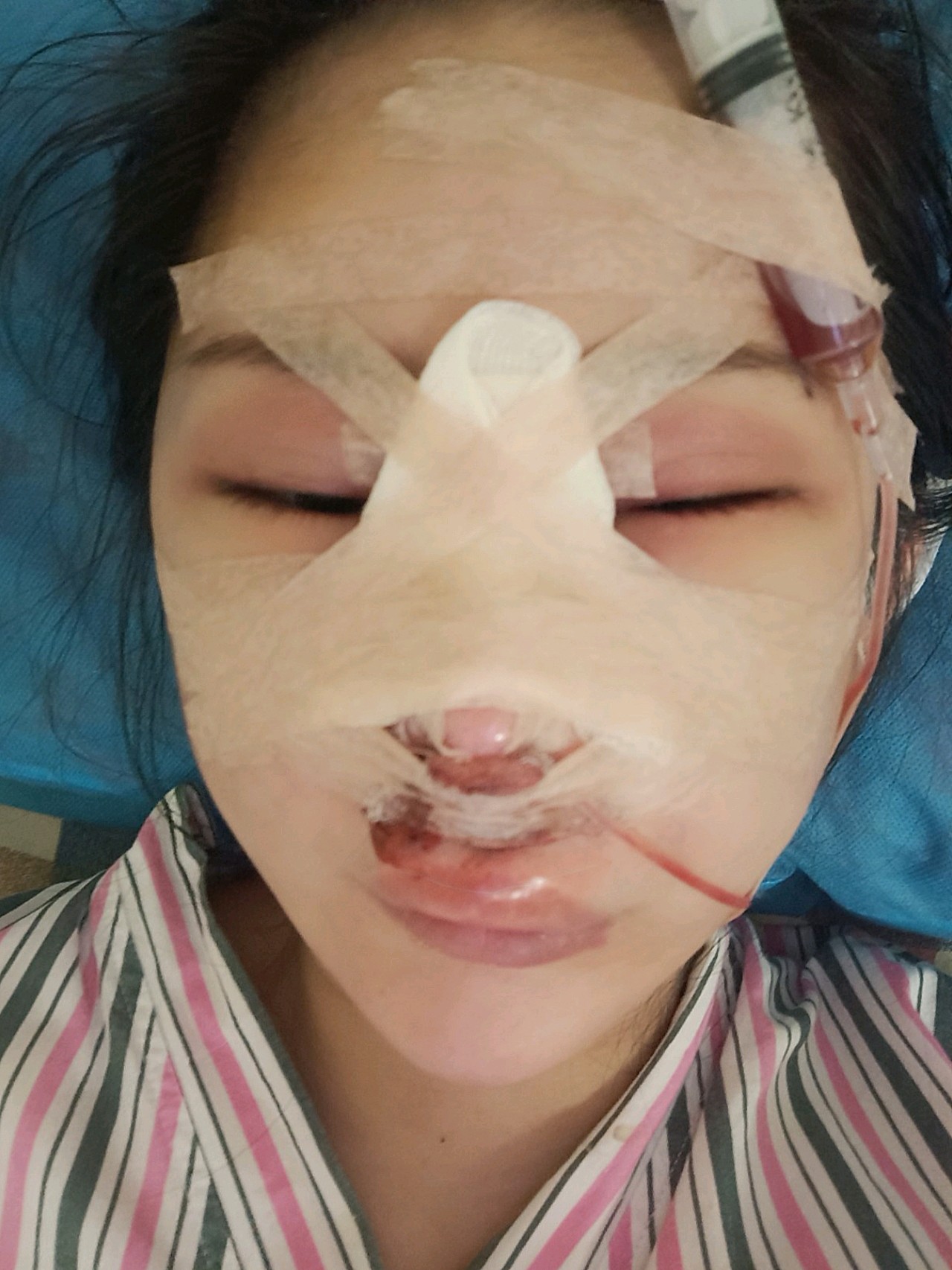 呵呵第一次就失败了,鼻小柱还缺块肉!我该怎么办?还能修复嘛?