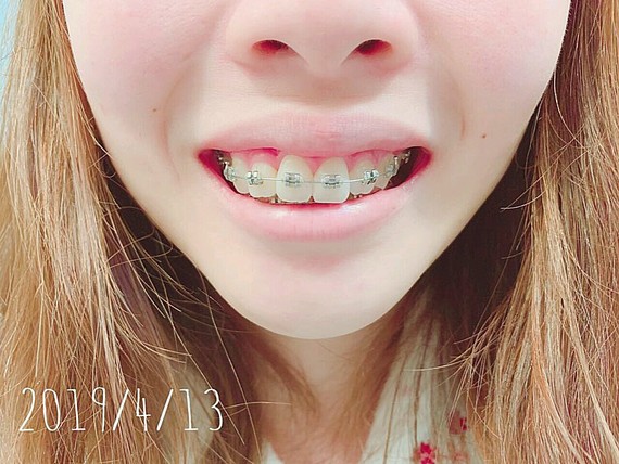 氧气bqmyu0 牙套4个月 基本上可以很自然的闭上嘴了,矫正牙齿前闭嘴都