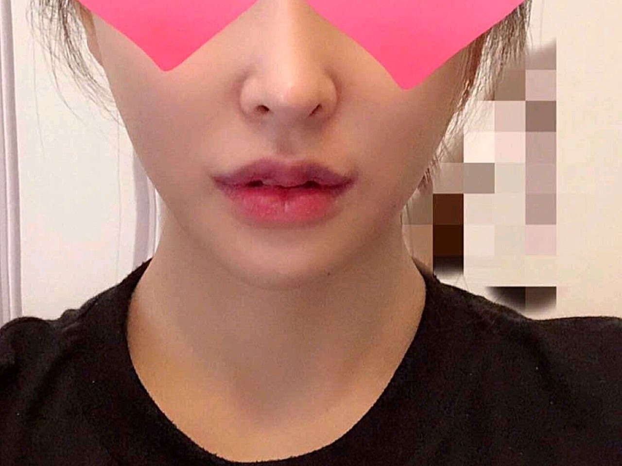 可能根据不同的人,想法不同,例如唇珠和唇峰的改善