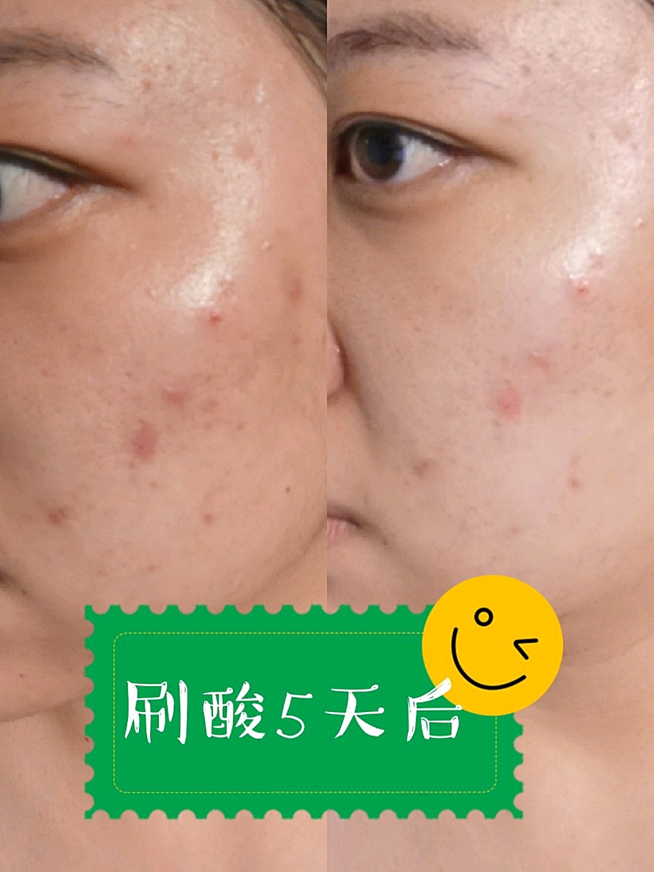 迪玛丝缇千人刷酸体验