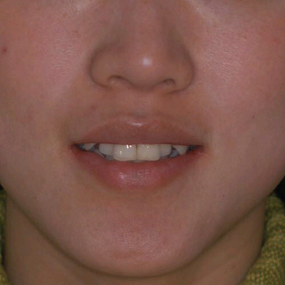 门牙和周围几颗有点前突,然后咬合不正,我这人总想追_圈子-新氧美容