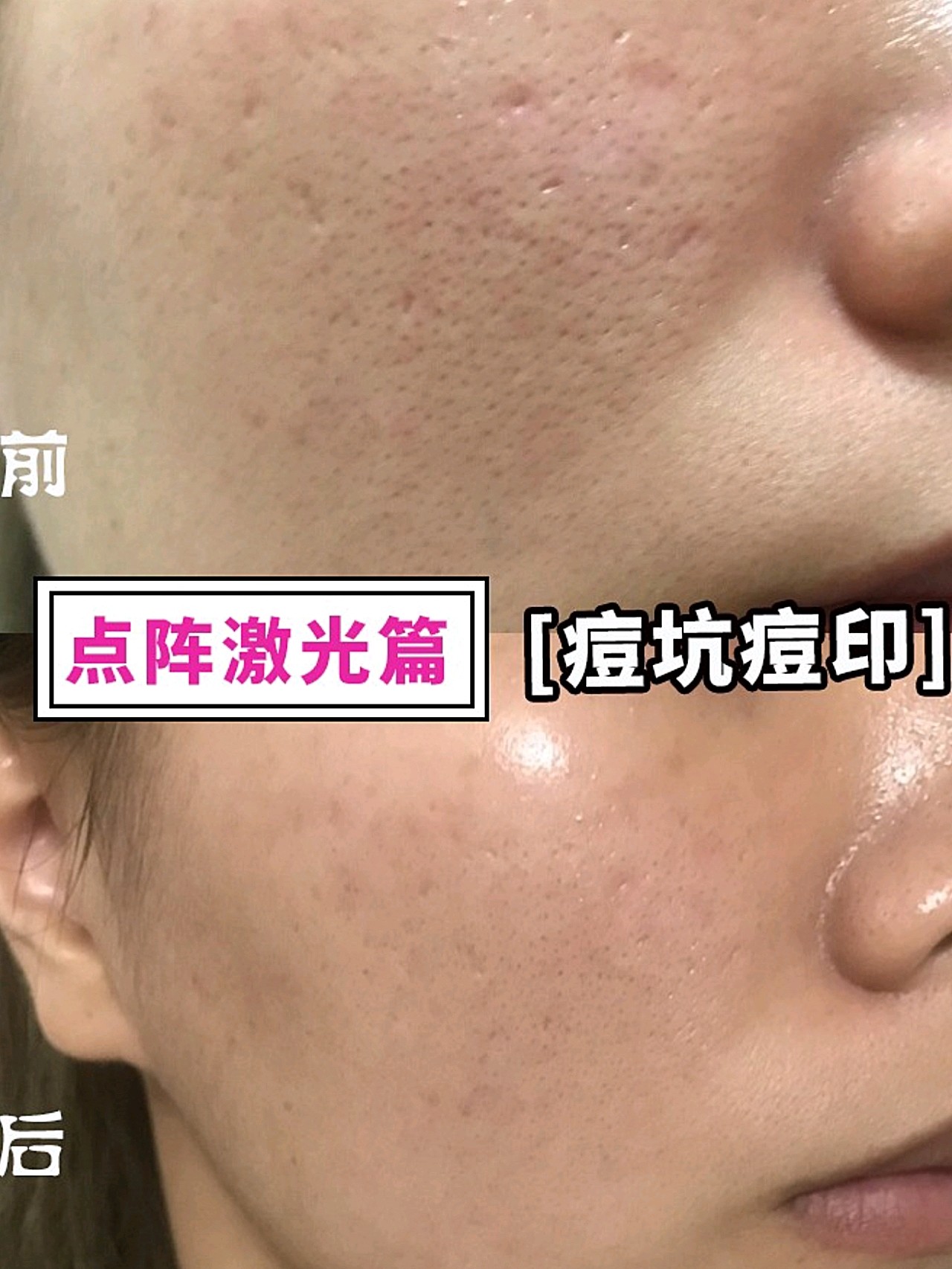 9797做完1次co2点阵激光祛痘坑,效果还是有的,但_圈子-新氧美容