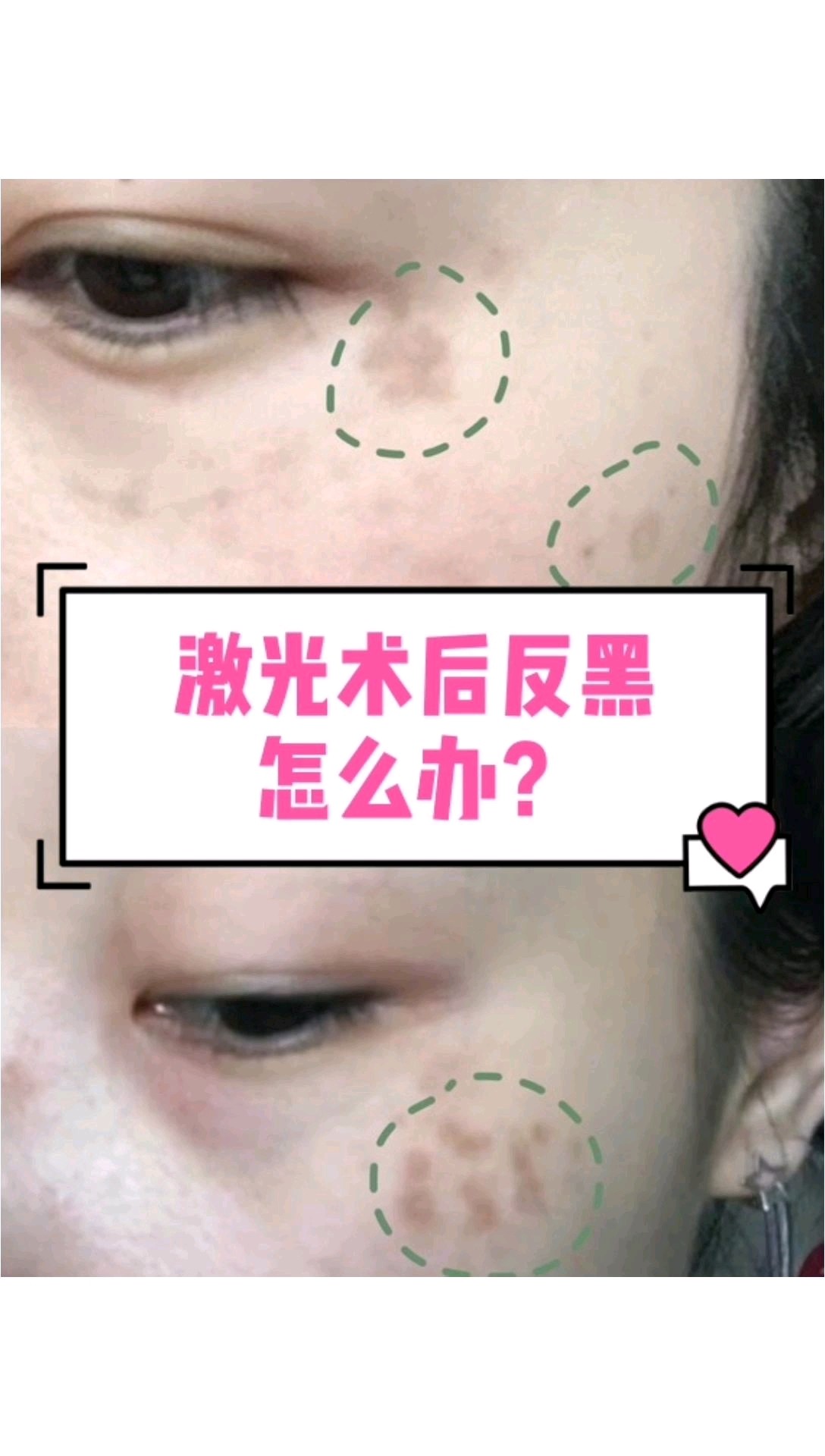 激光术后反黑怎么办?激光美白,祛斑,明明想要更白,_圈子-新氧美容整形
