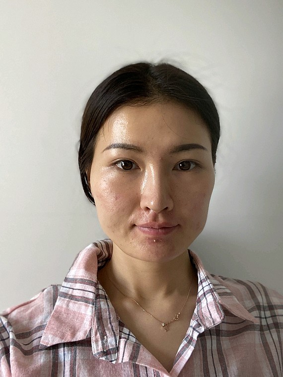 一直对自己的面部不满意,太阳穴凹陷,苹果肌凹陷,脸_圈子-新氧美容