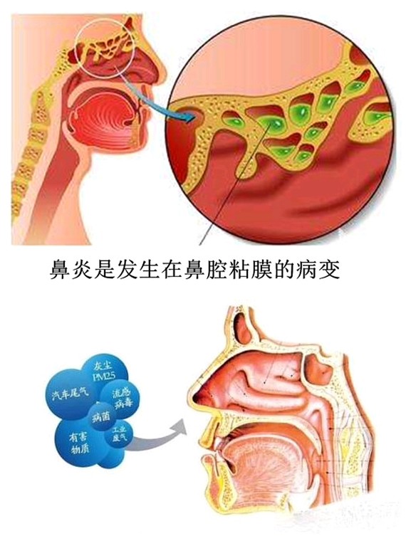 一个鼻子拯救一张脸鼻炎有166急性和266慢性鼻炎两_圈子-新氧