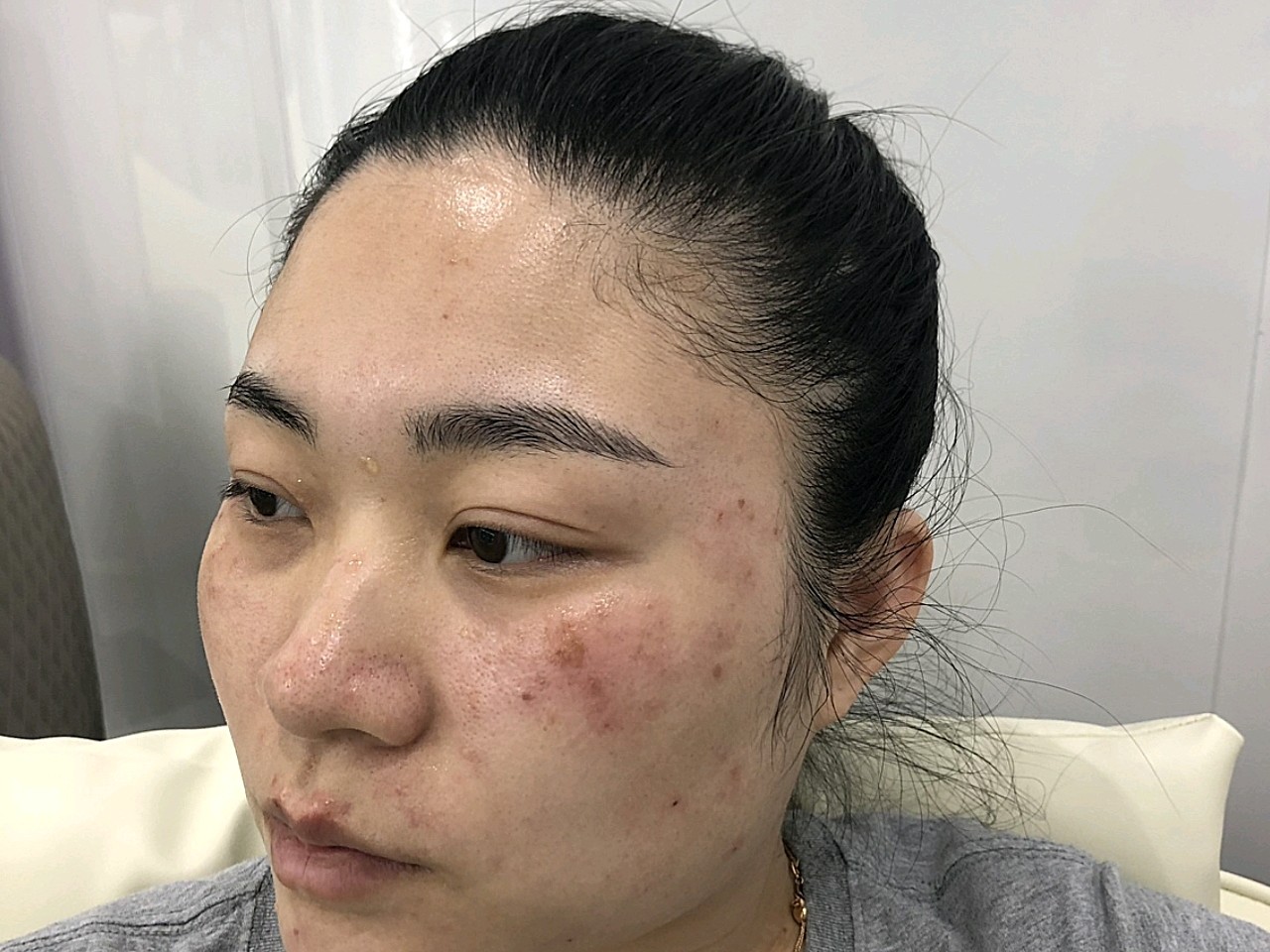 我皮肤本身比较白,就是有些小斑点,不多在颧骨地方