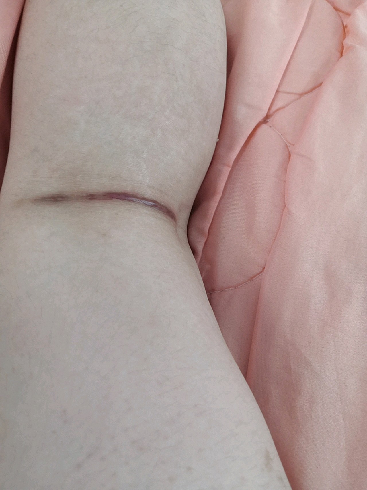 大腿抽脂已经快五个月了,疤痕依然丝毫没有退去,就在膝盖后侧,特别深